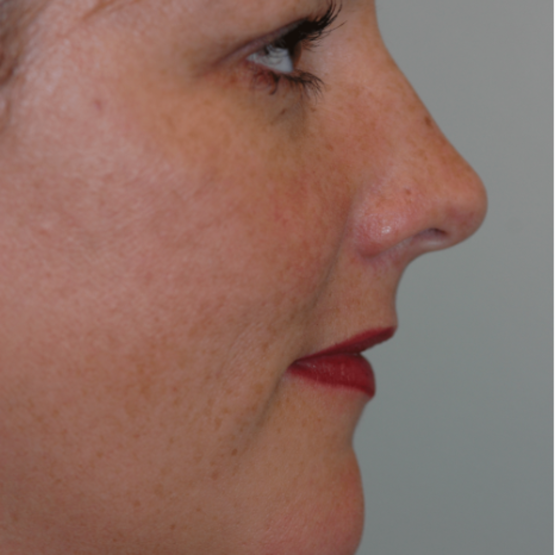 Case--9236 | Before Medical Grade Skincare