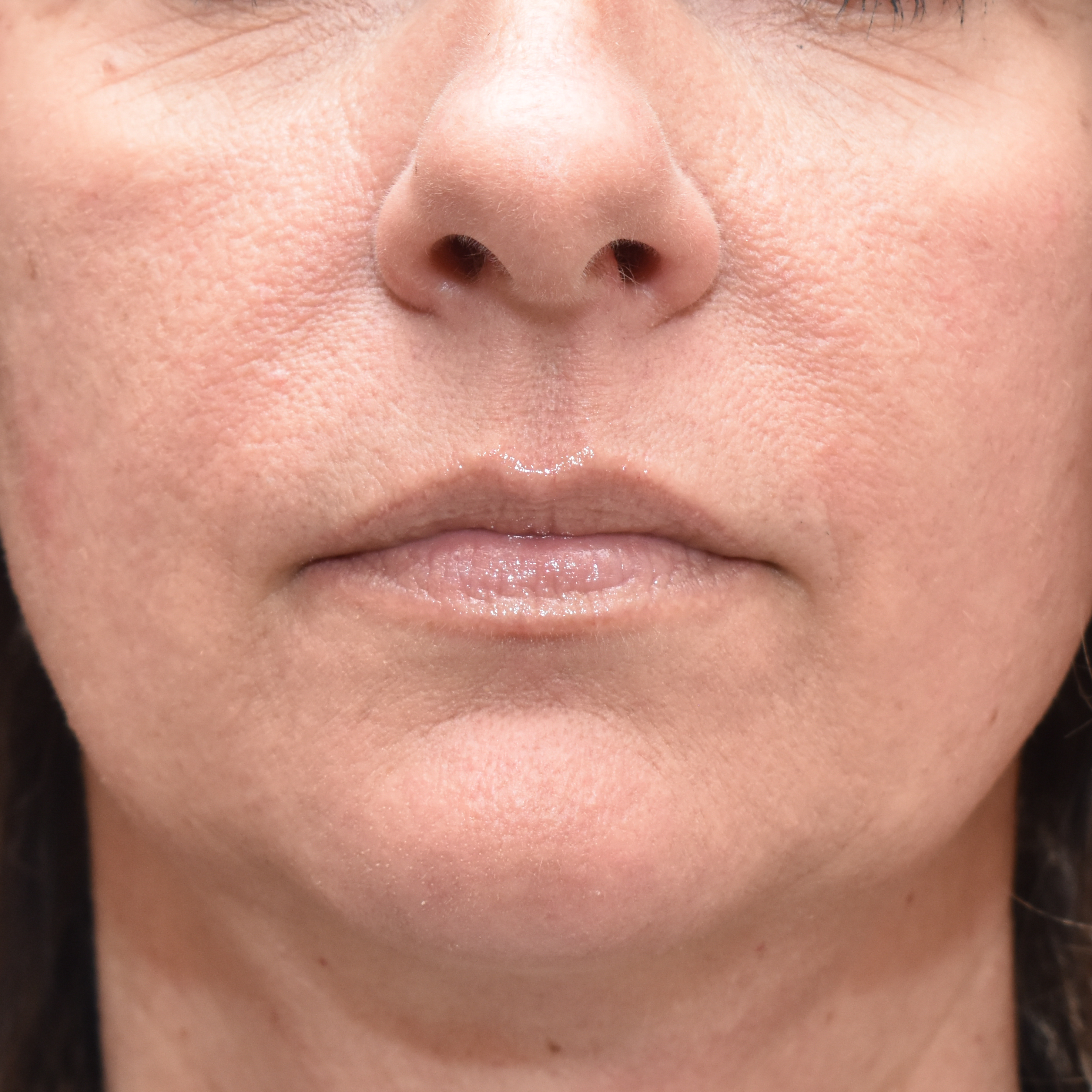 Case--4475 | Before Facial Fillers 1