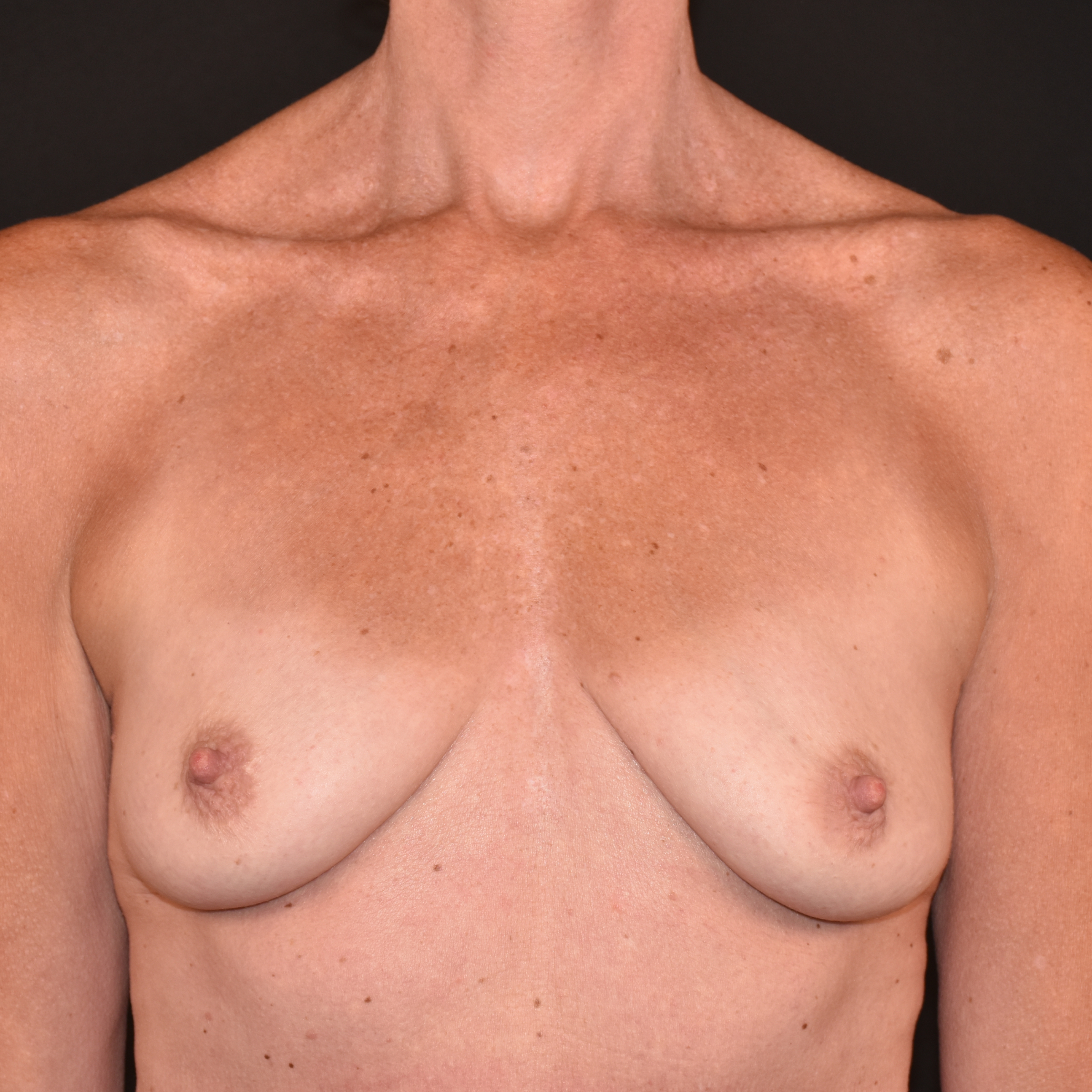 Case--6257 | Before Breast Augmentation with Lift