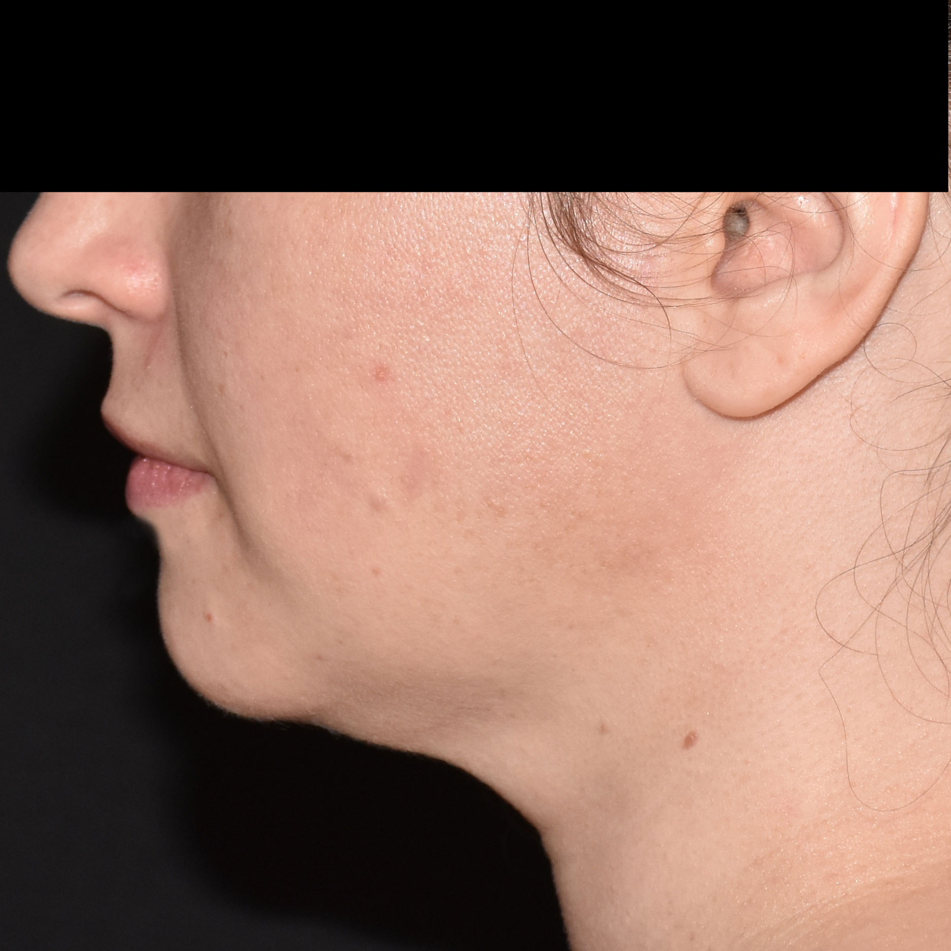 Case--8379 | After Skin Tightening 3