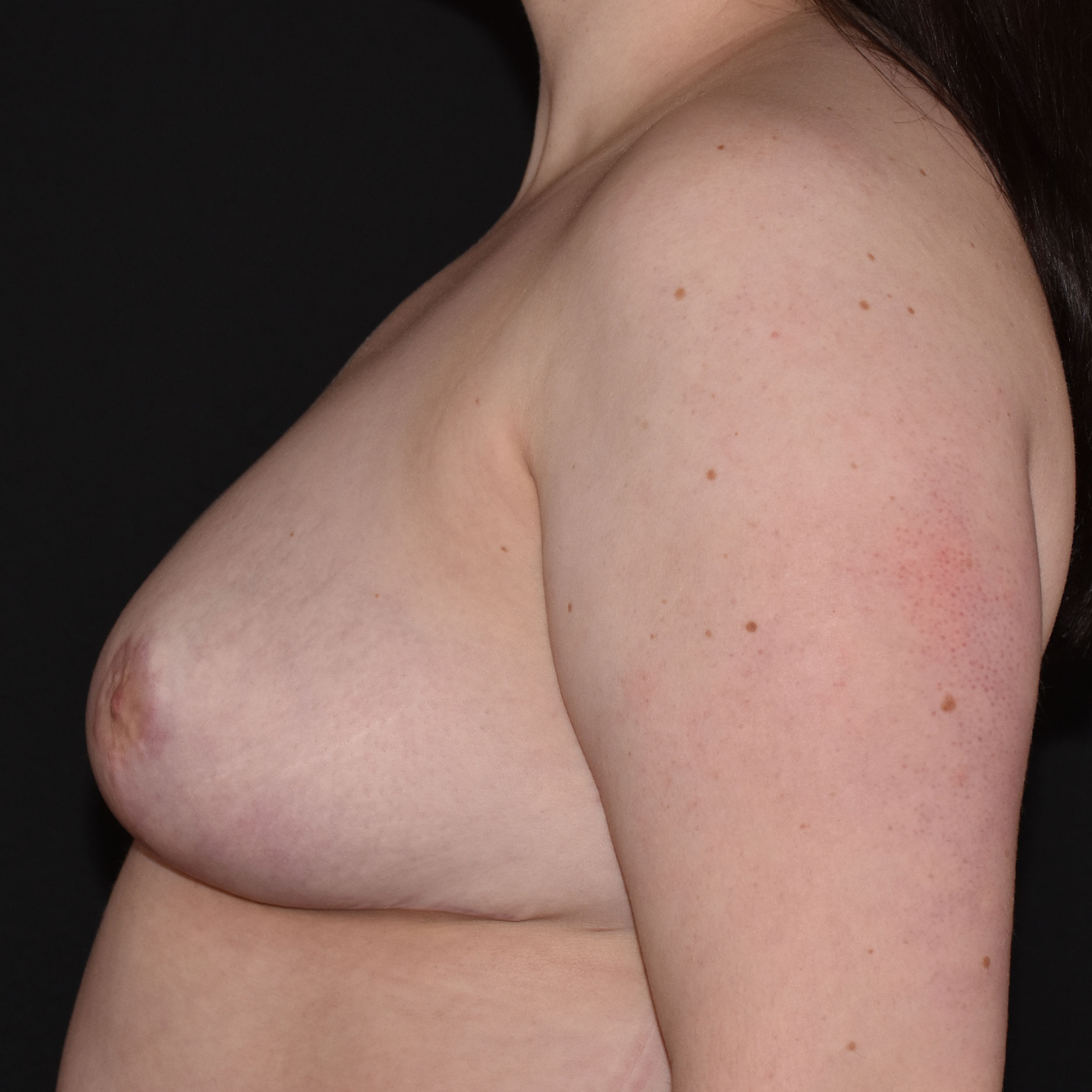 Case--5915 | After Breast Reduction 3