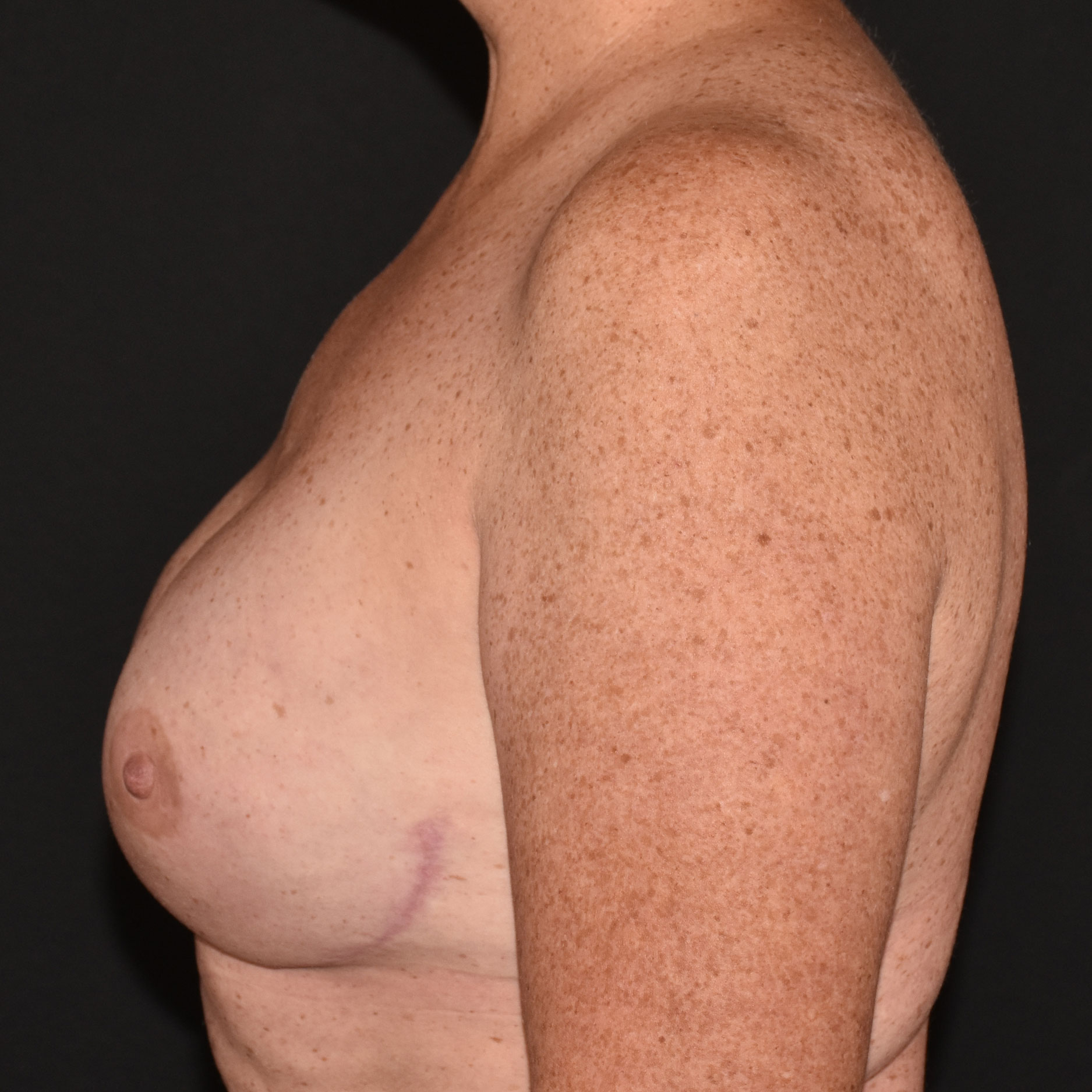 Case--9226 | After Breast Reconstruction 3