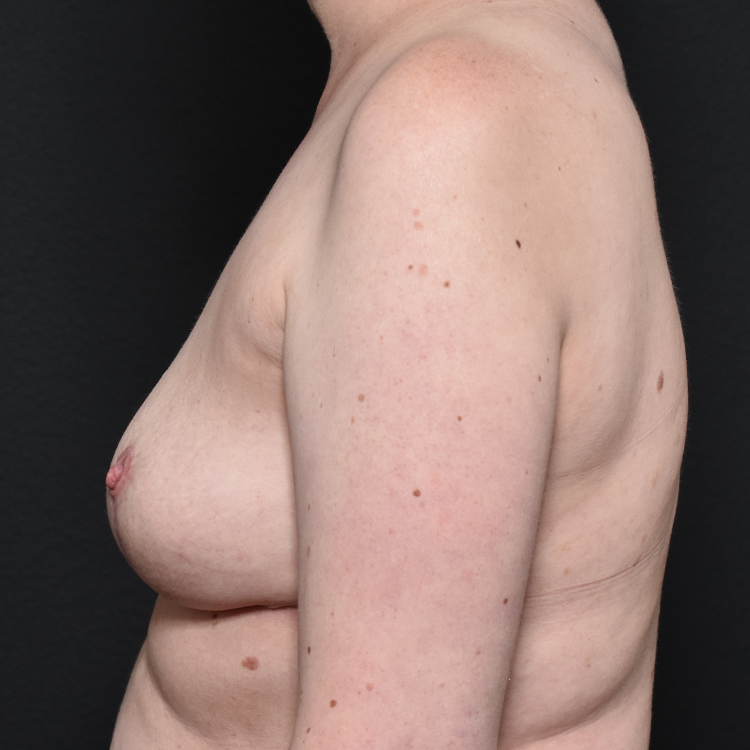 Case--6804 | After Breast Implant Removal or Revision 3