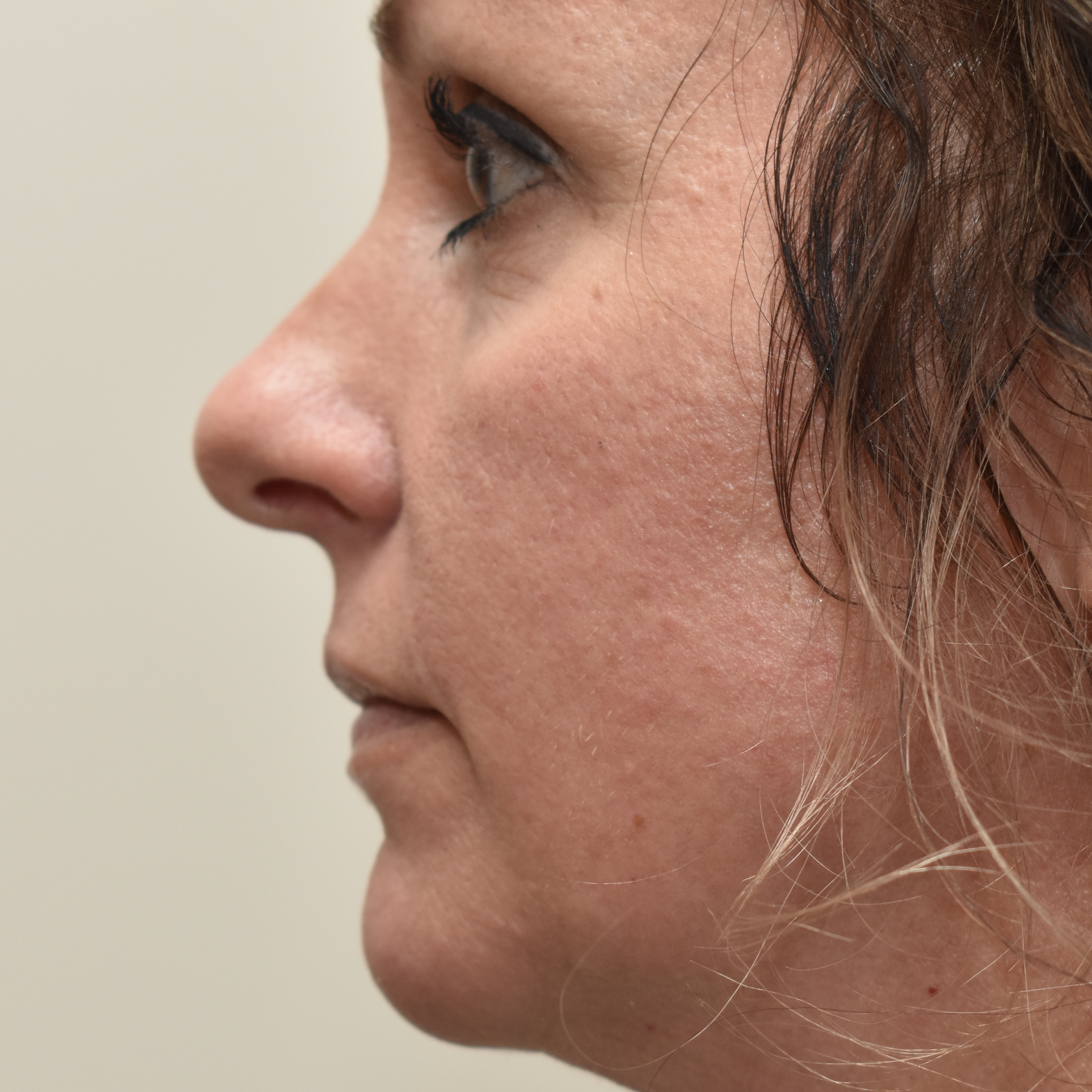Case--4475 | Before Facial Fillers 2