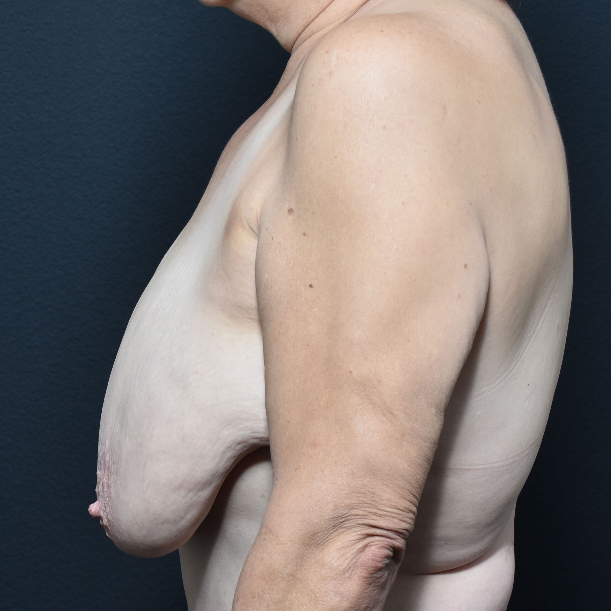 Case--7925 | Before Breast Reduction 2