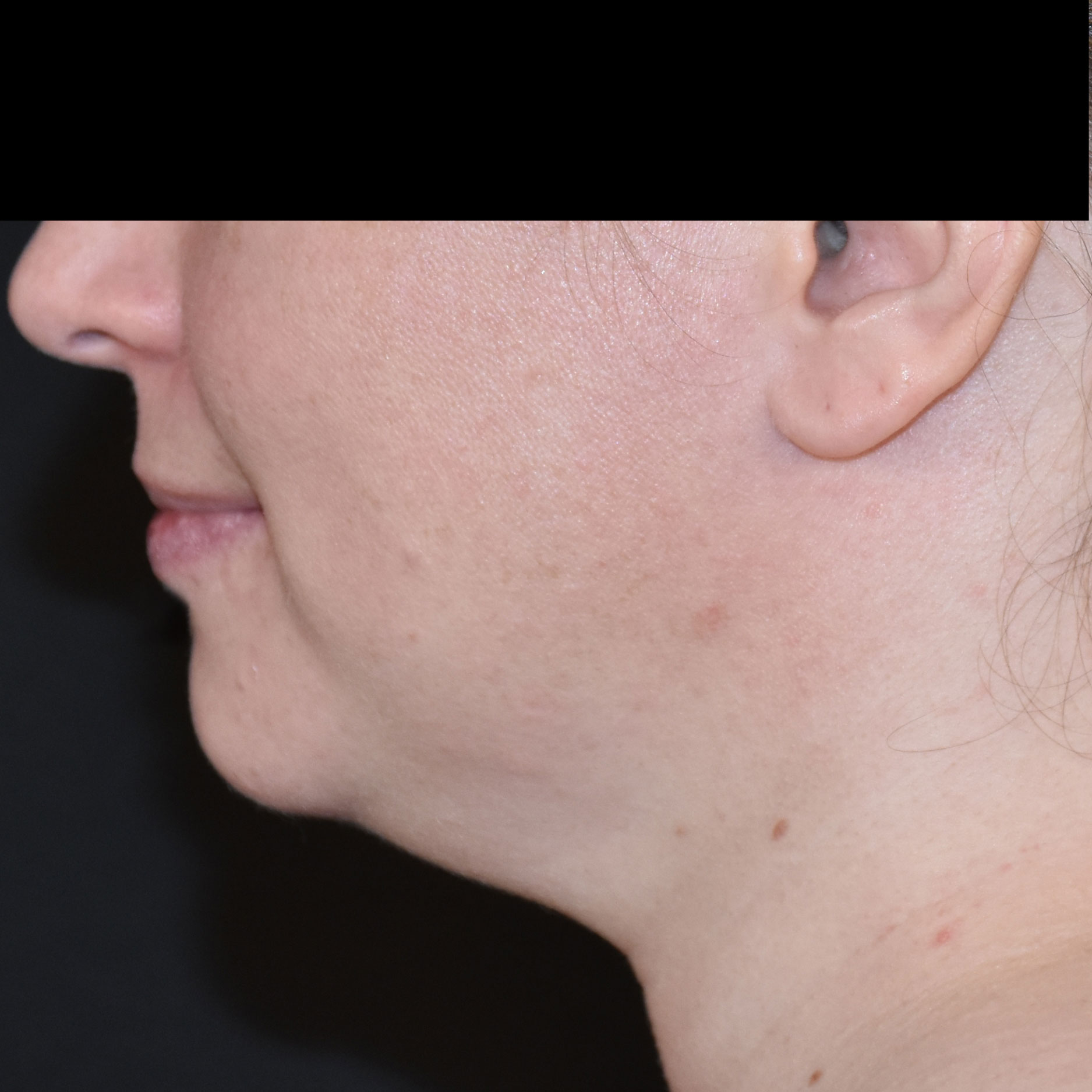 Case--8379 | Before Skin Tightening 3