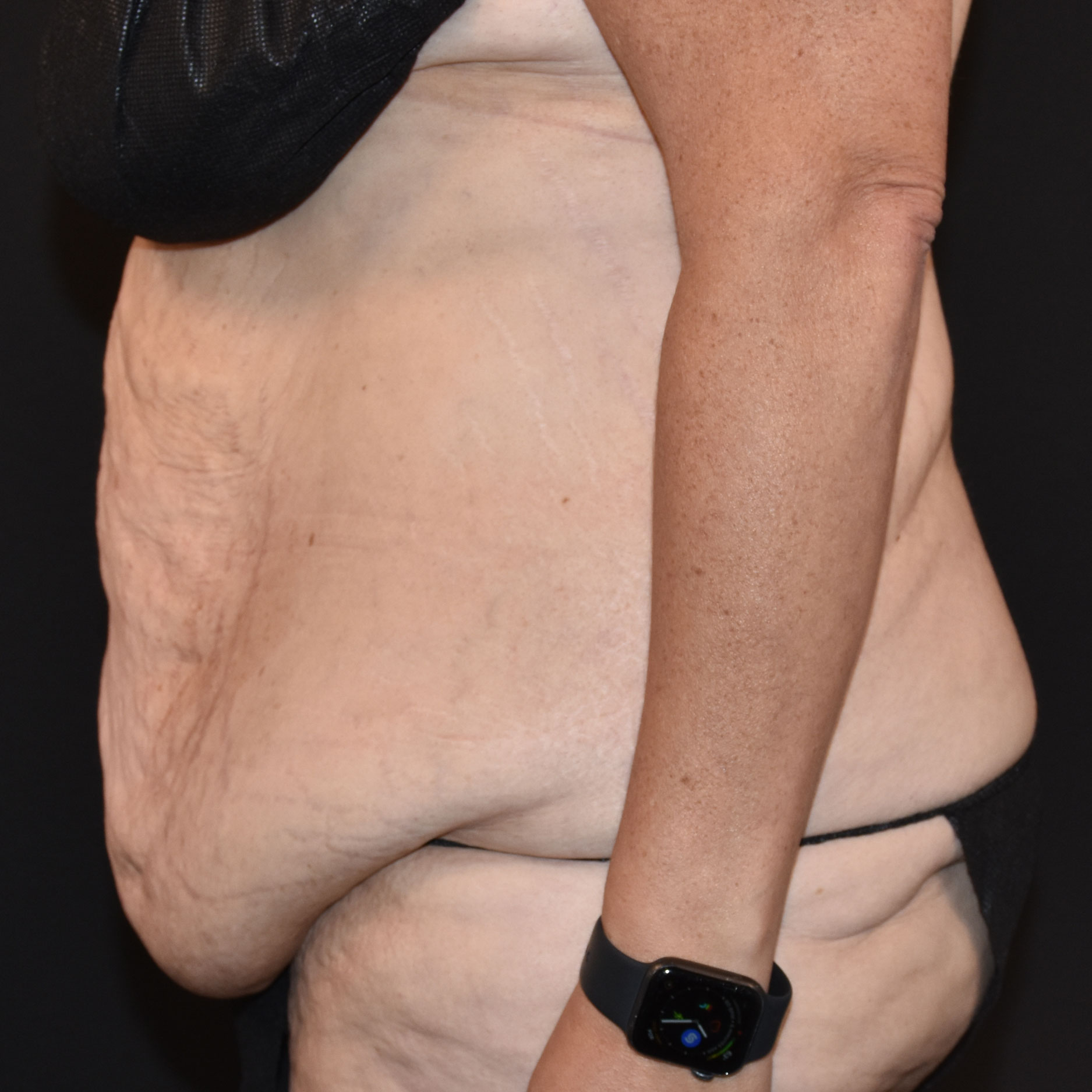 Case--2416 | Before Tummy Tuck 3