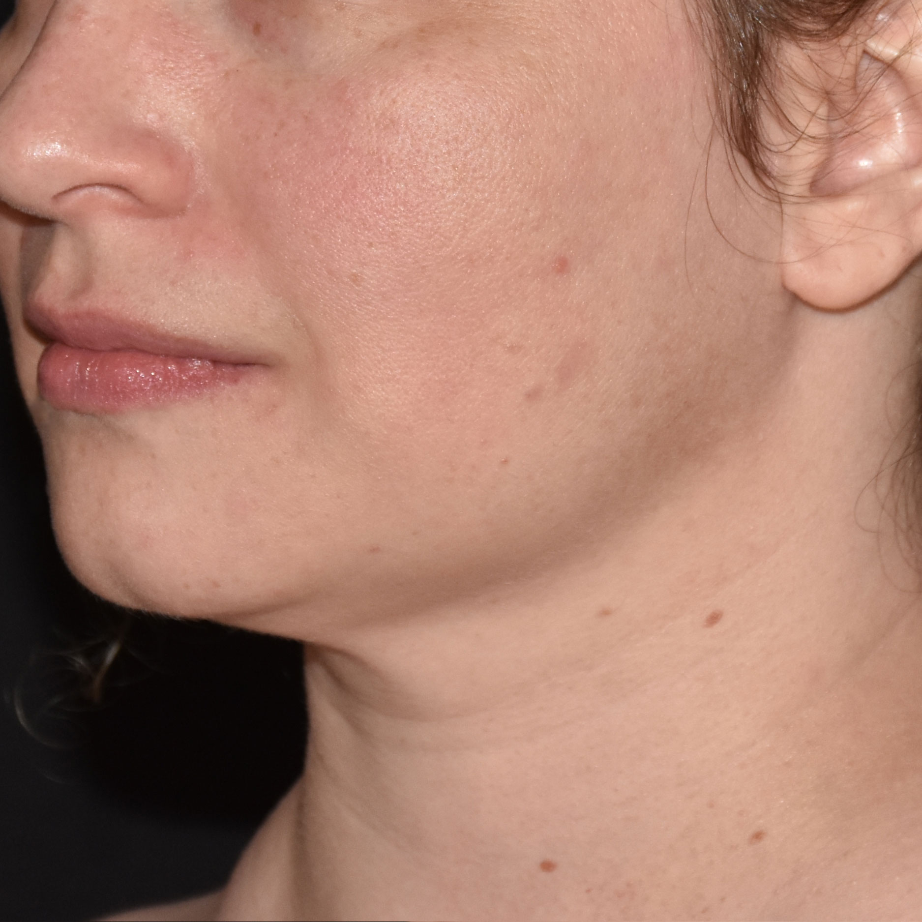 Case--8379 | After Skin Tightening 2