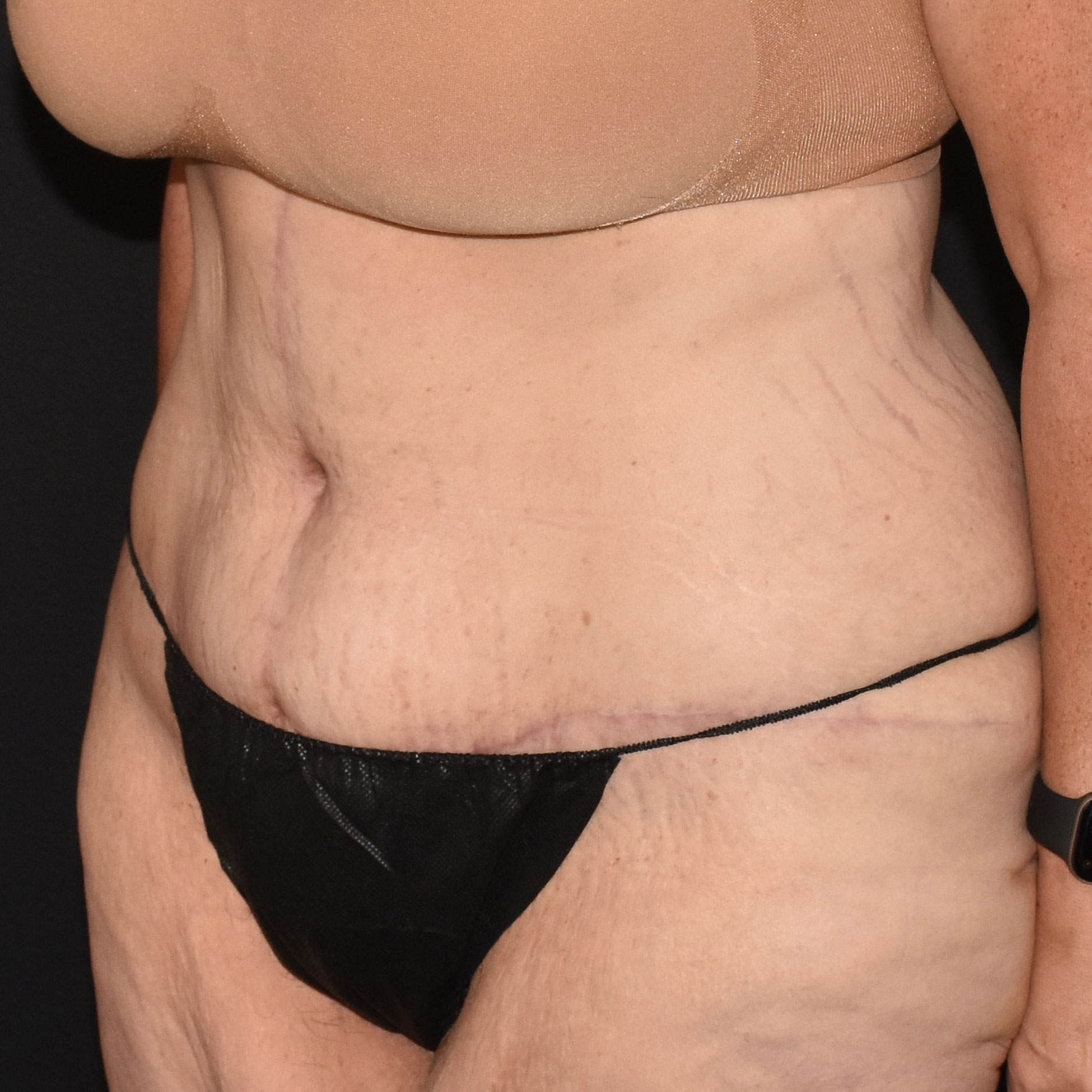 Case--2416 | After Tummy Tuck 2