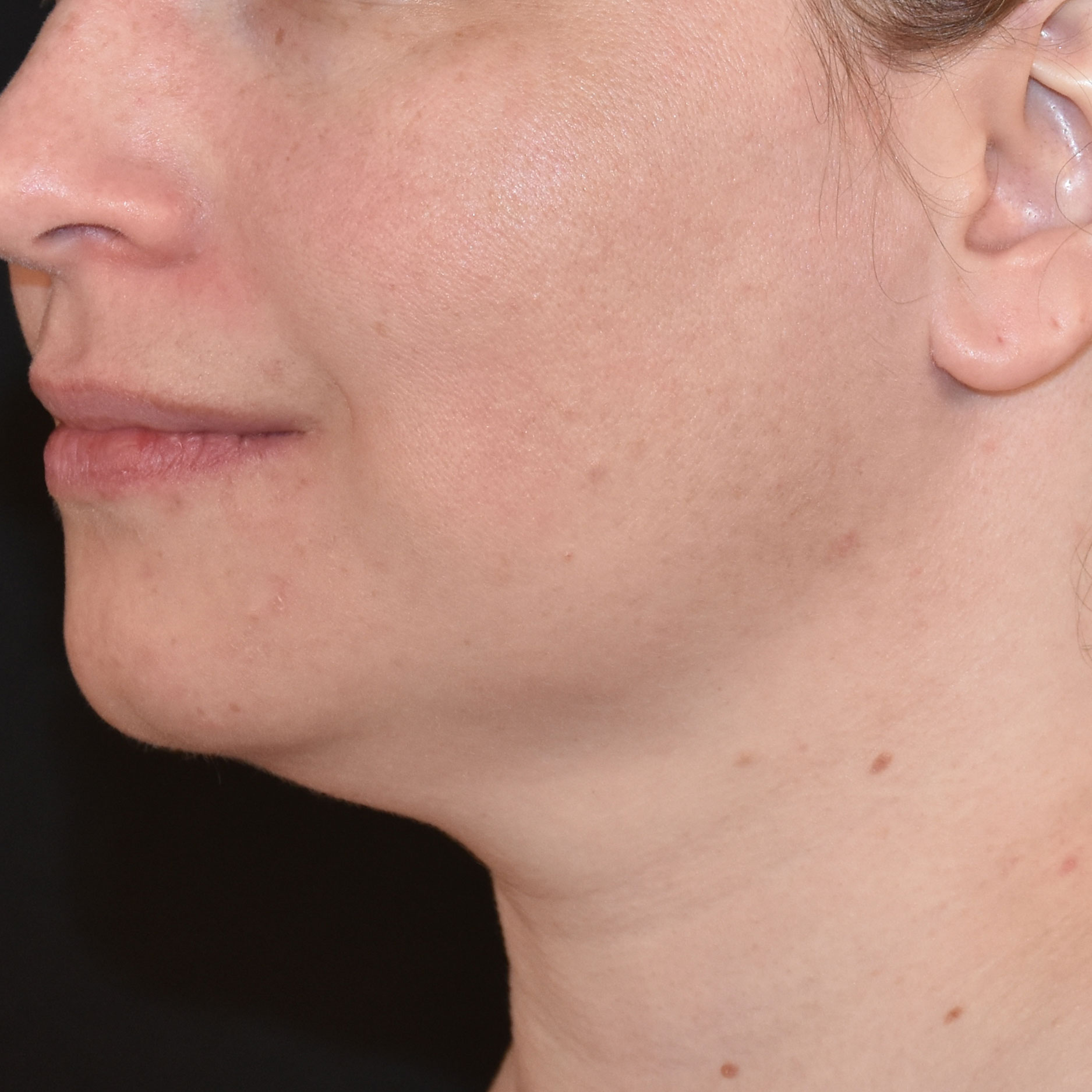 Case--8379 | Before Skin Tightening 2