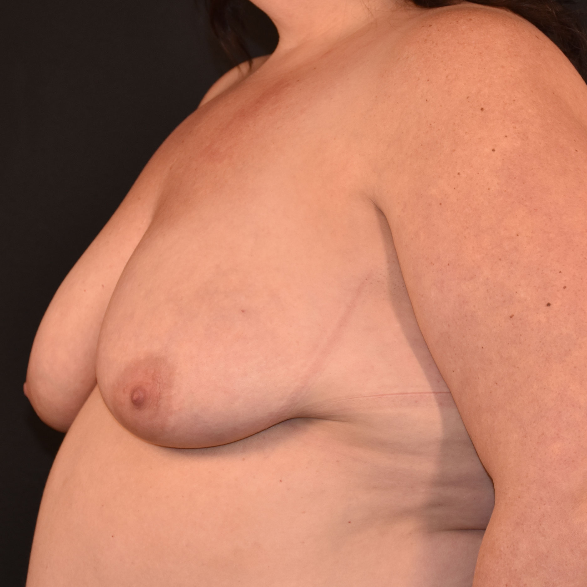 Case--1637 | Before Breast Reconstruction 2