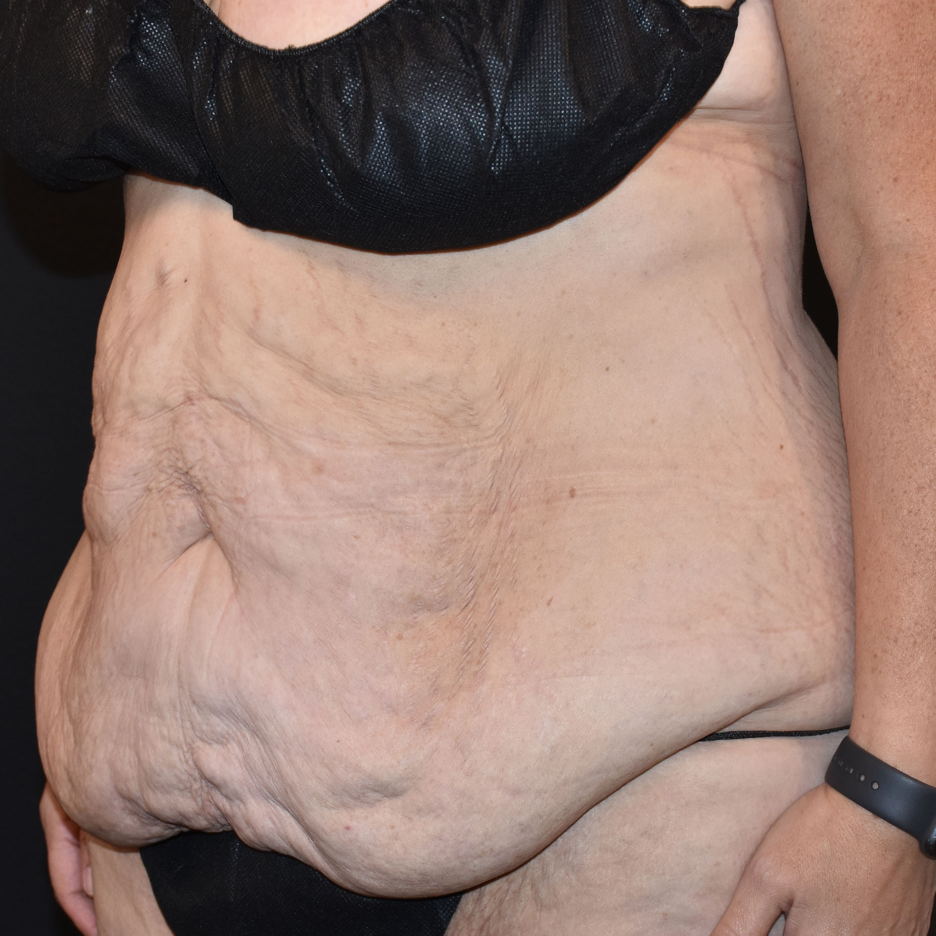 Case--2416 | Before Tummy Tuck 2