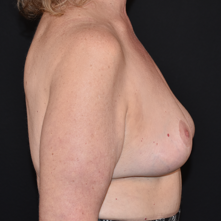 Case--6257 | After Breast Implant Removal or Revision 3