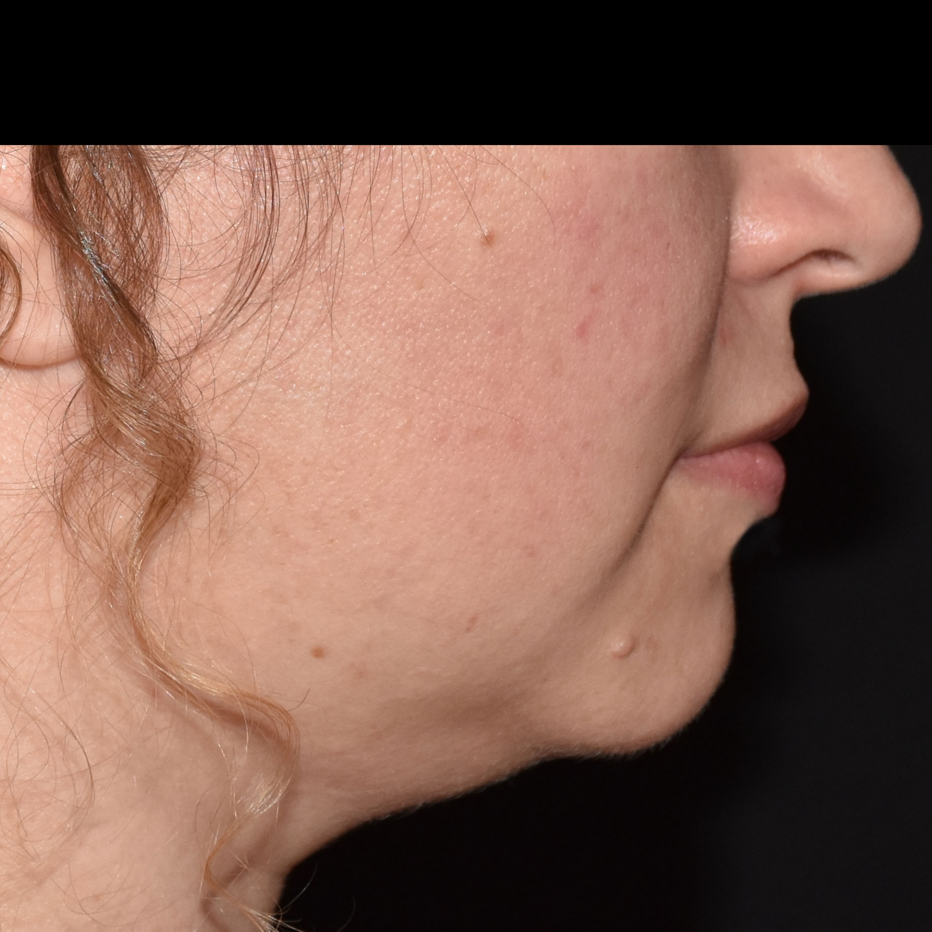 Case--8379 | After Skin Tightening 4