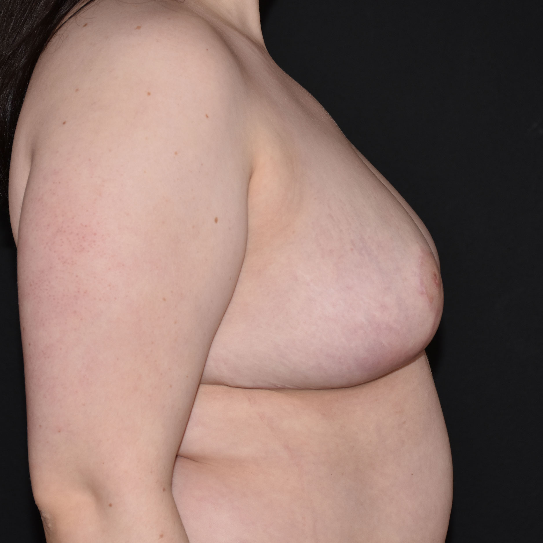 Case--5915 | After Breast Reduction 5