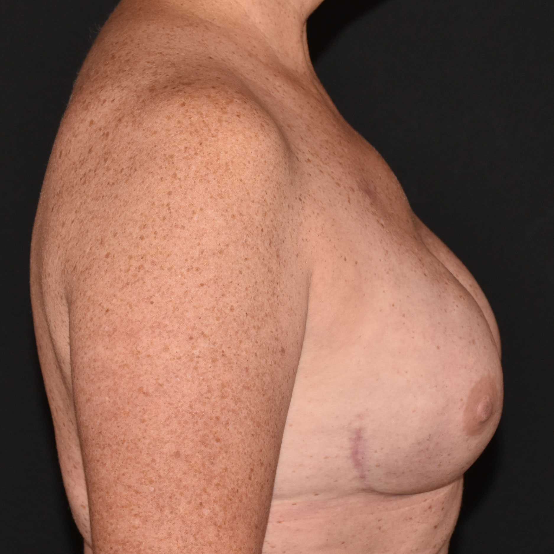 Case--9226 | After Breast Reconstruction 5