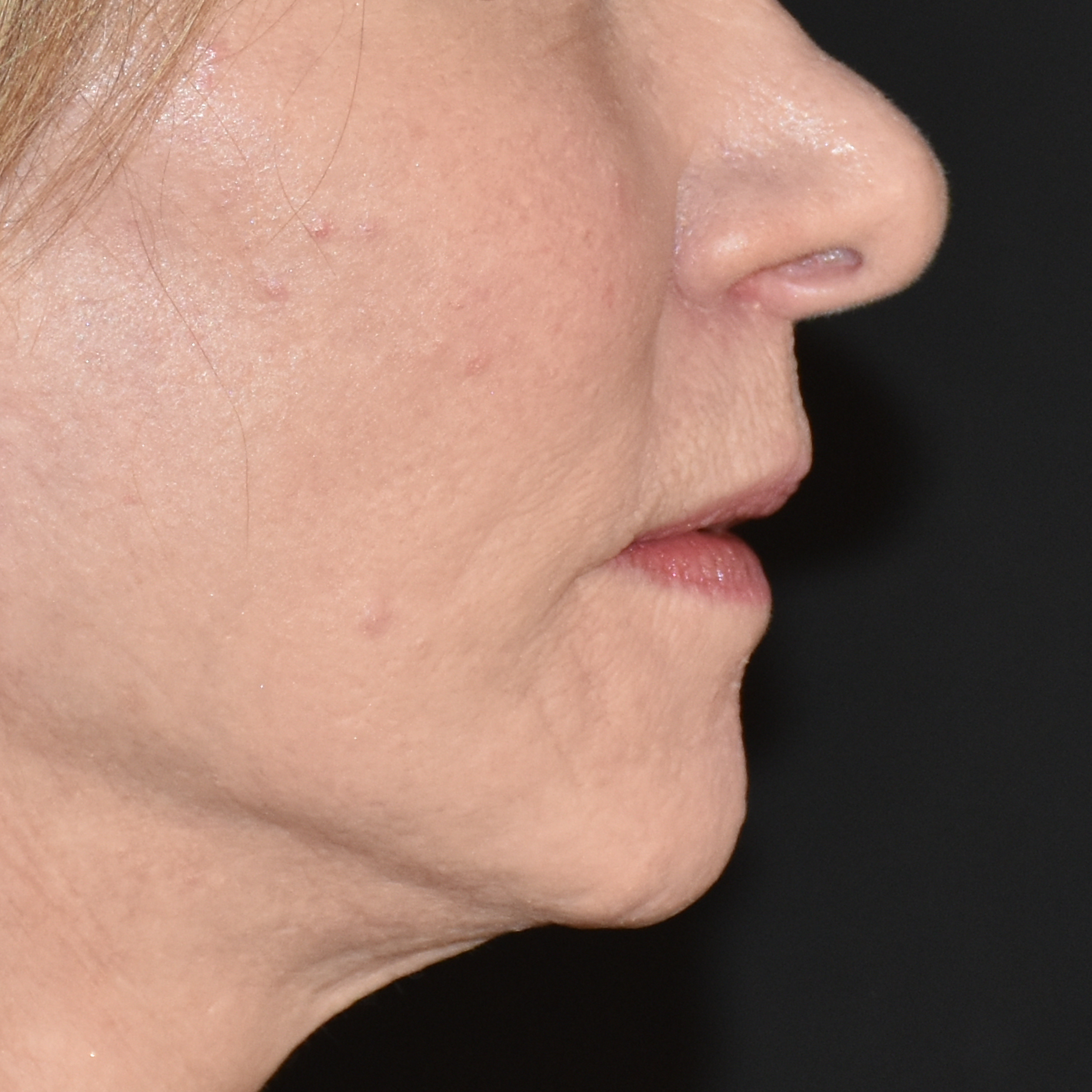 Case--5516 | After Lip Lift 2