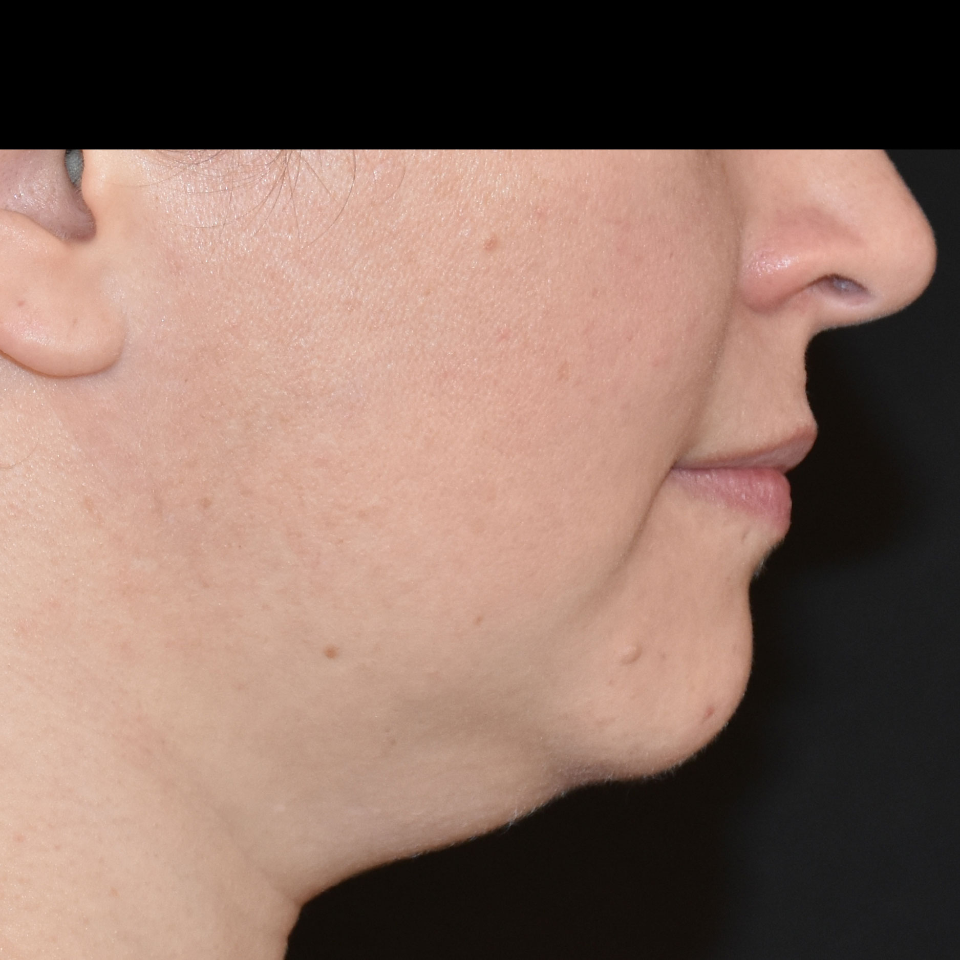 Case--8379 | Before Skin Tightening 4