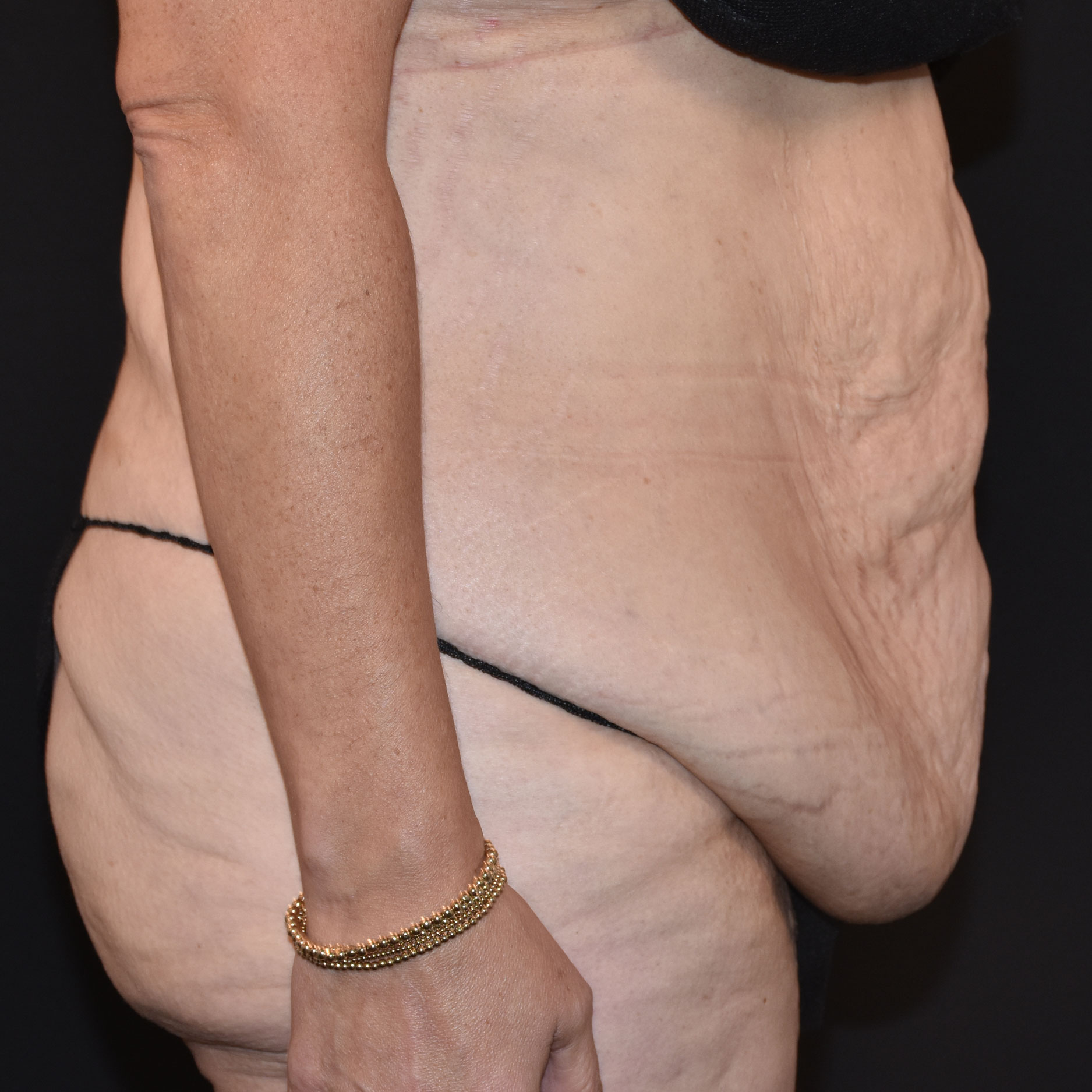 Case--2416 | Before Tummy Tuck 5