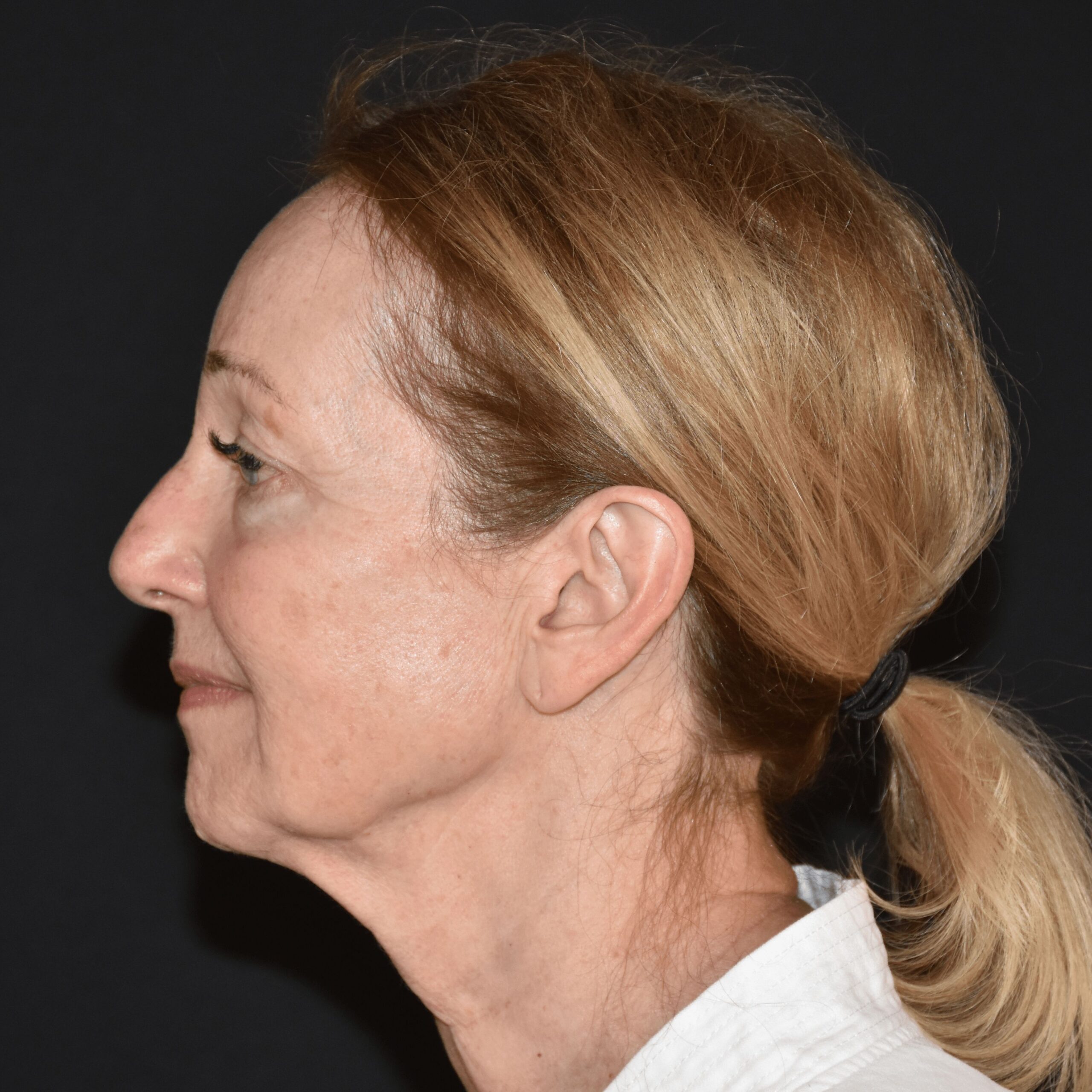 Case--8366 | Before Facial Micro Fat Grafting 3