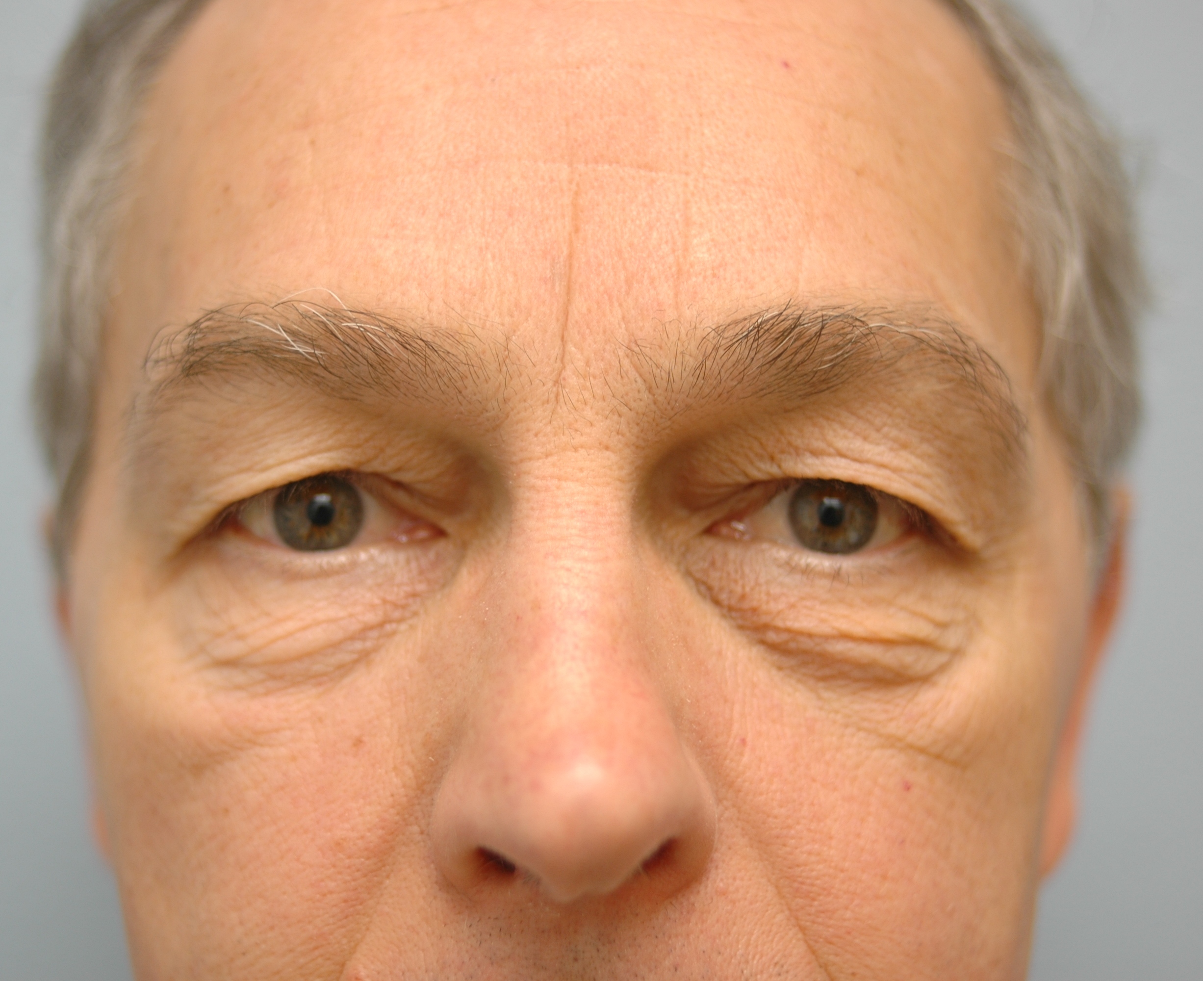 Case--4034 | Before Lower Blepharoplasty