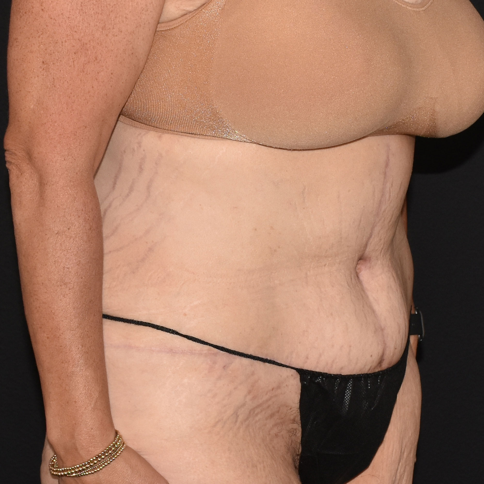 Case--2416 | After Tummy Tuck 4