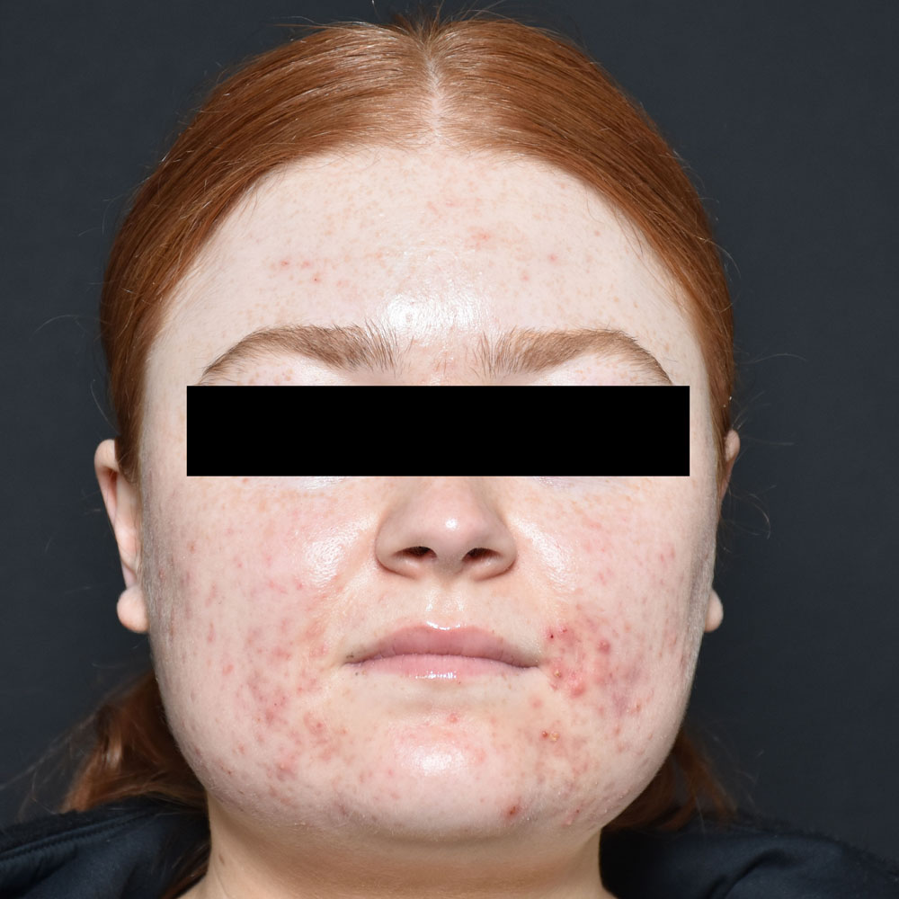 Case--2122 | Before Face Treatments