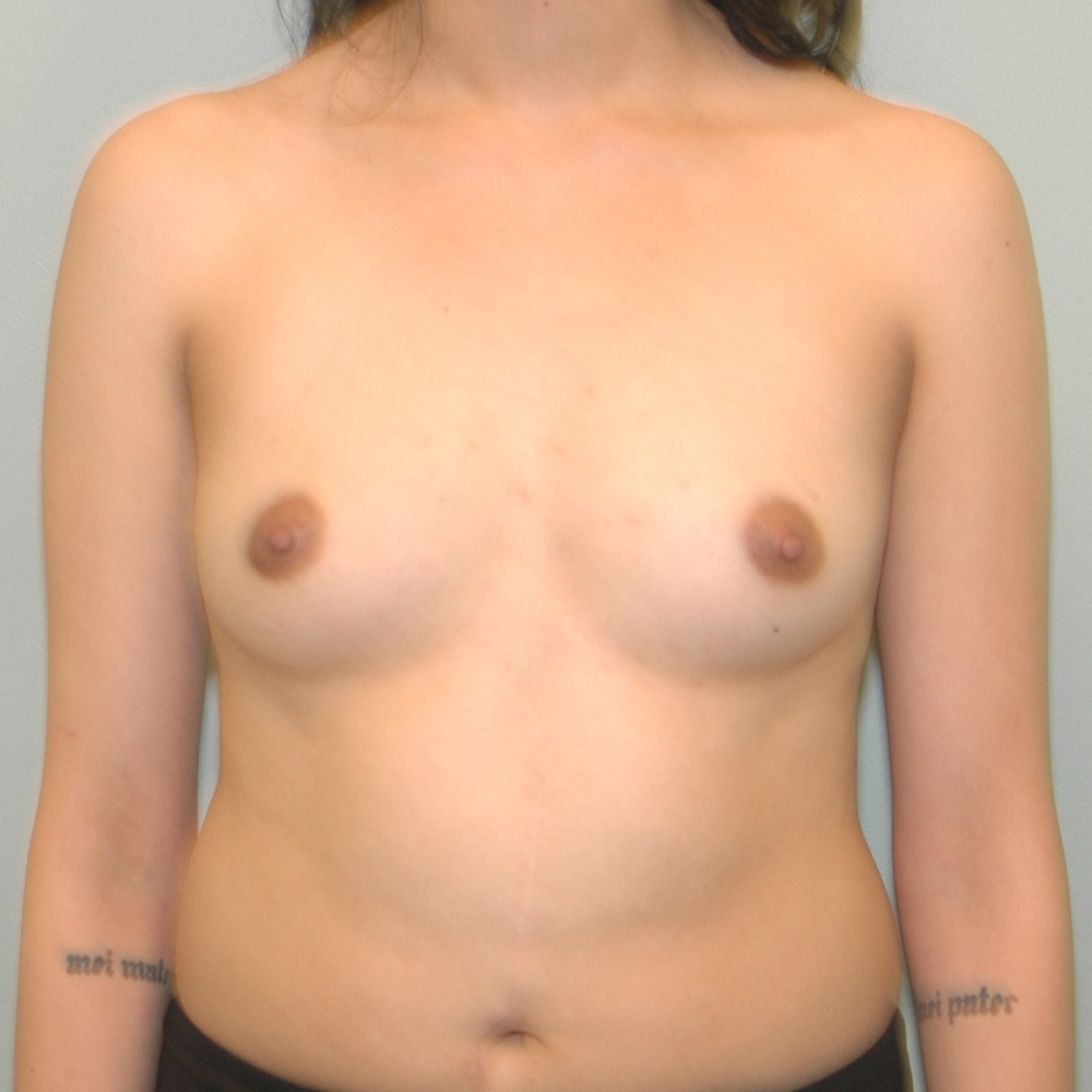 Case--2042 | Before Breast Augmentation 1