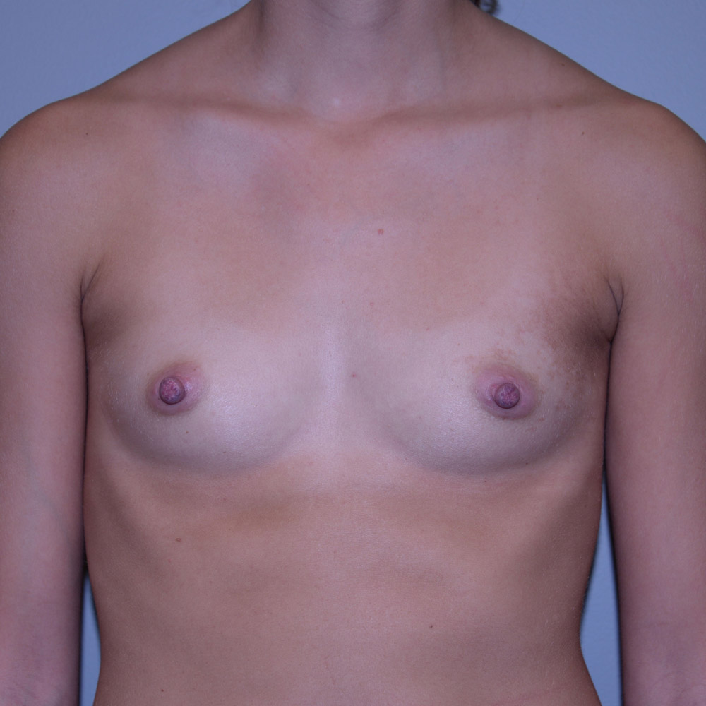 Case--2043 | Before Breast Augmentation 1
