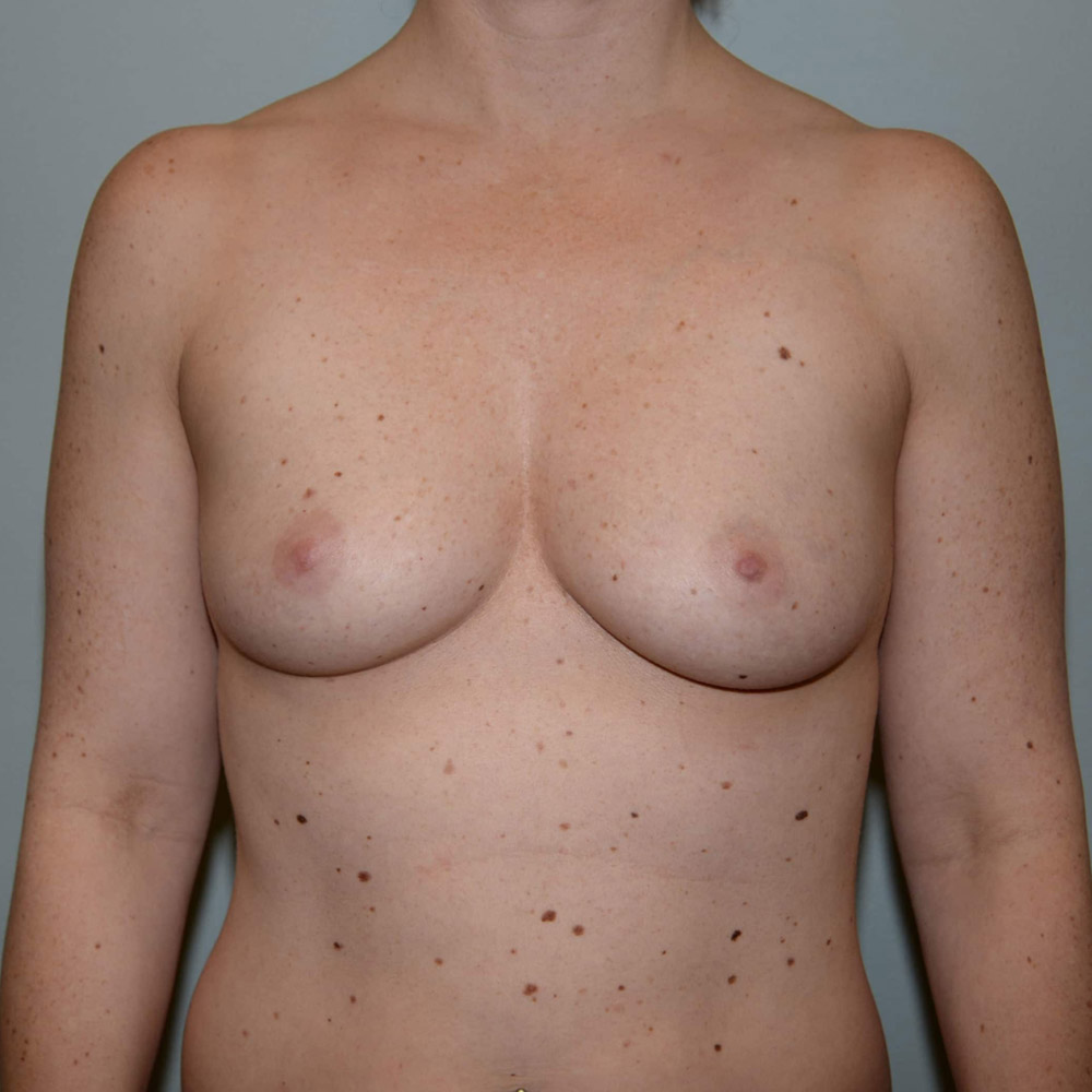 Case--2079 | Before Breast Augmentation