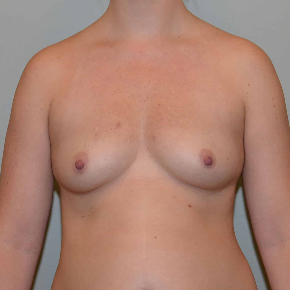 Case--2082 | Before Breast Augmentation