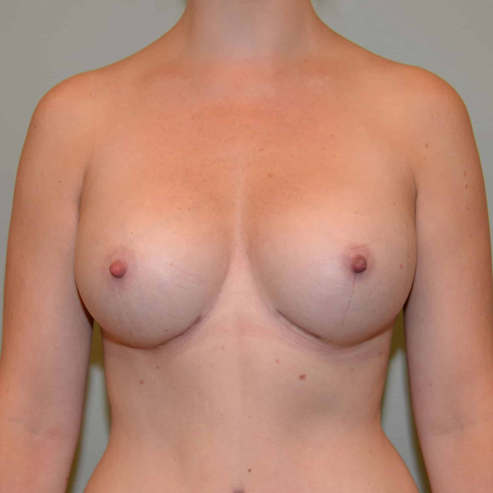 Case--2082 | After Breast Augmentation
