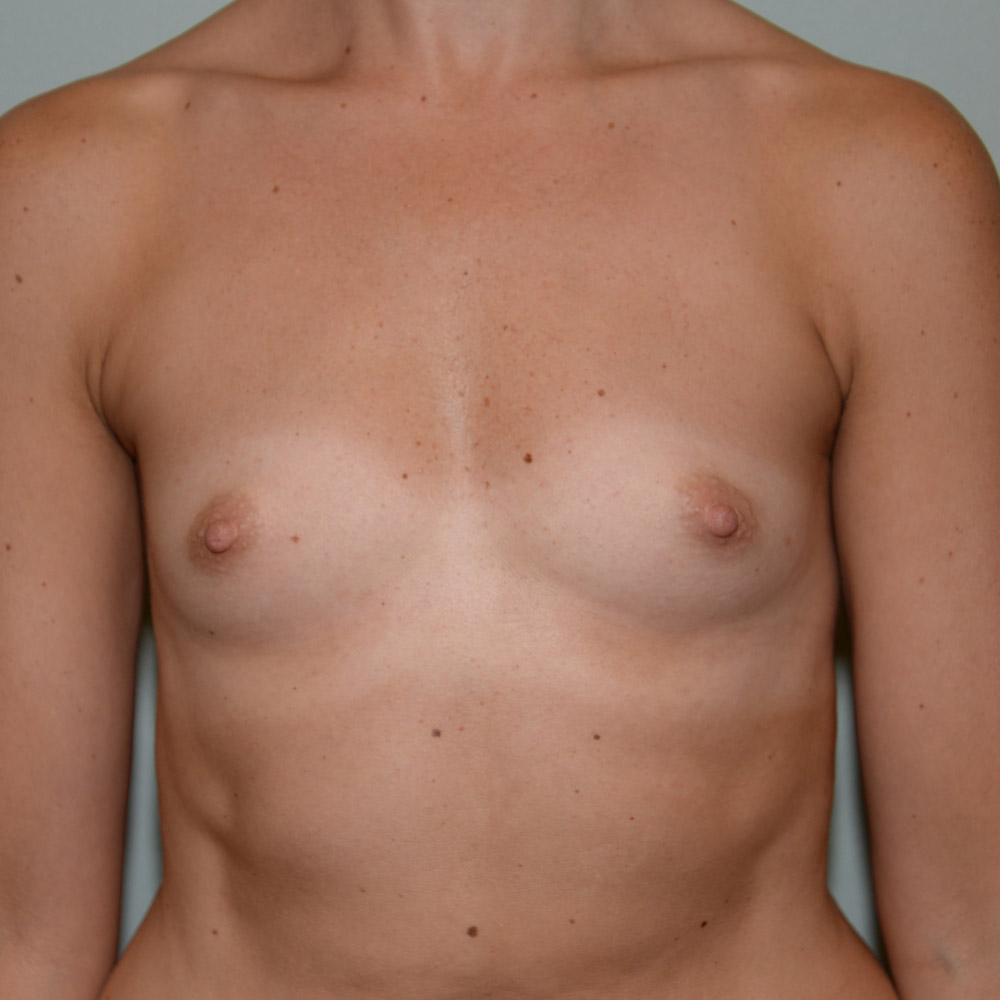 Case--2054 | Before Breast Augmentation