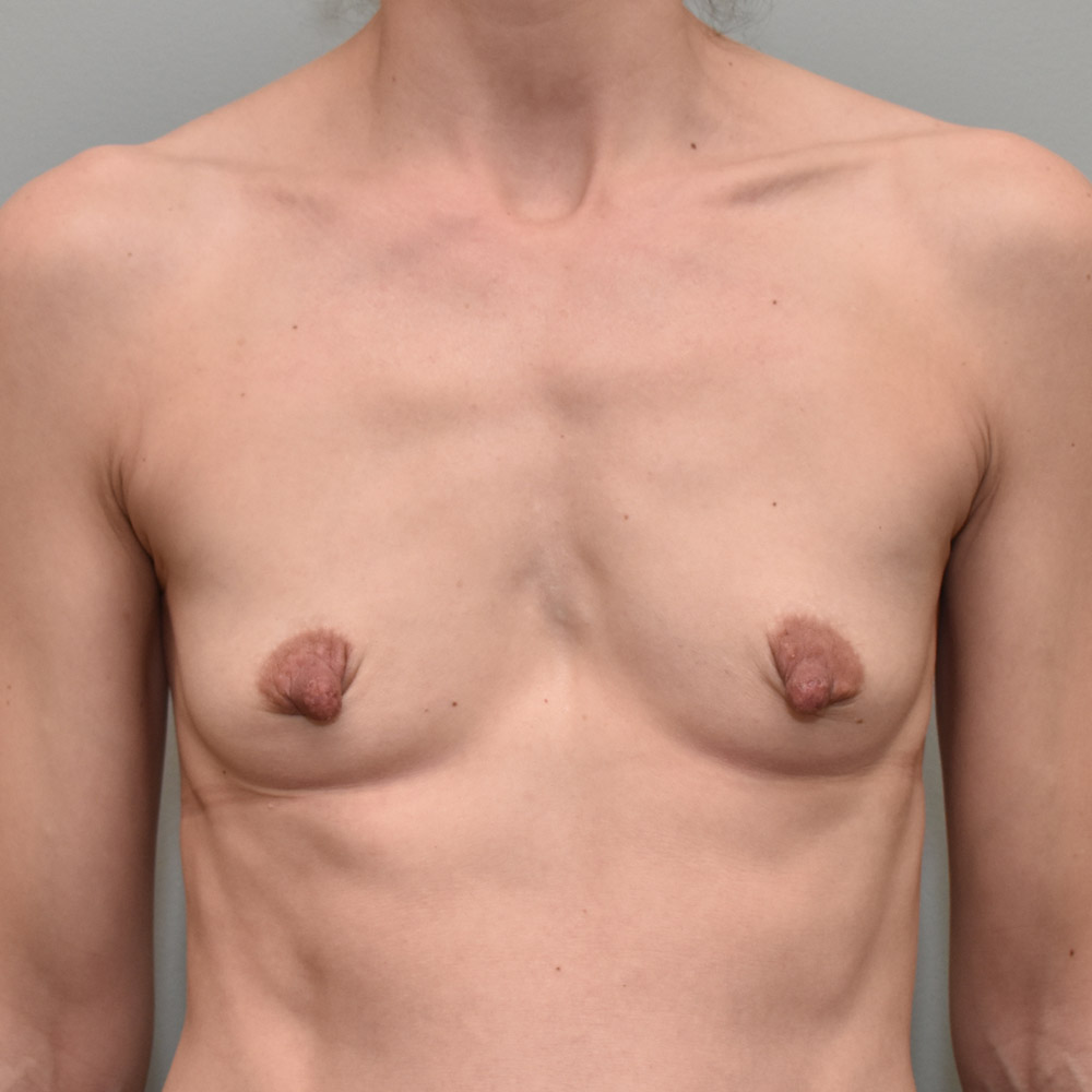 Case--2062 | Before Breast Augmentation