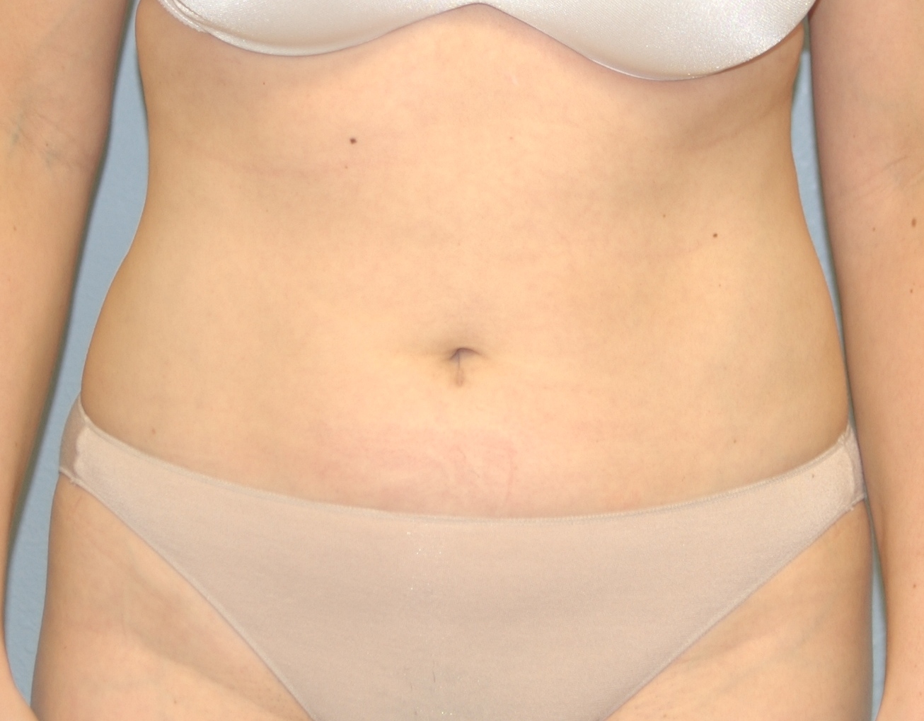 Case--9160 | After Liposuction 1