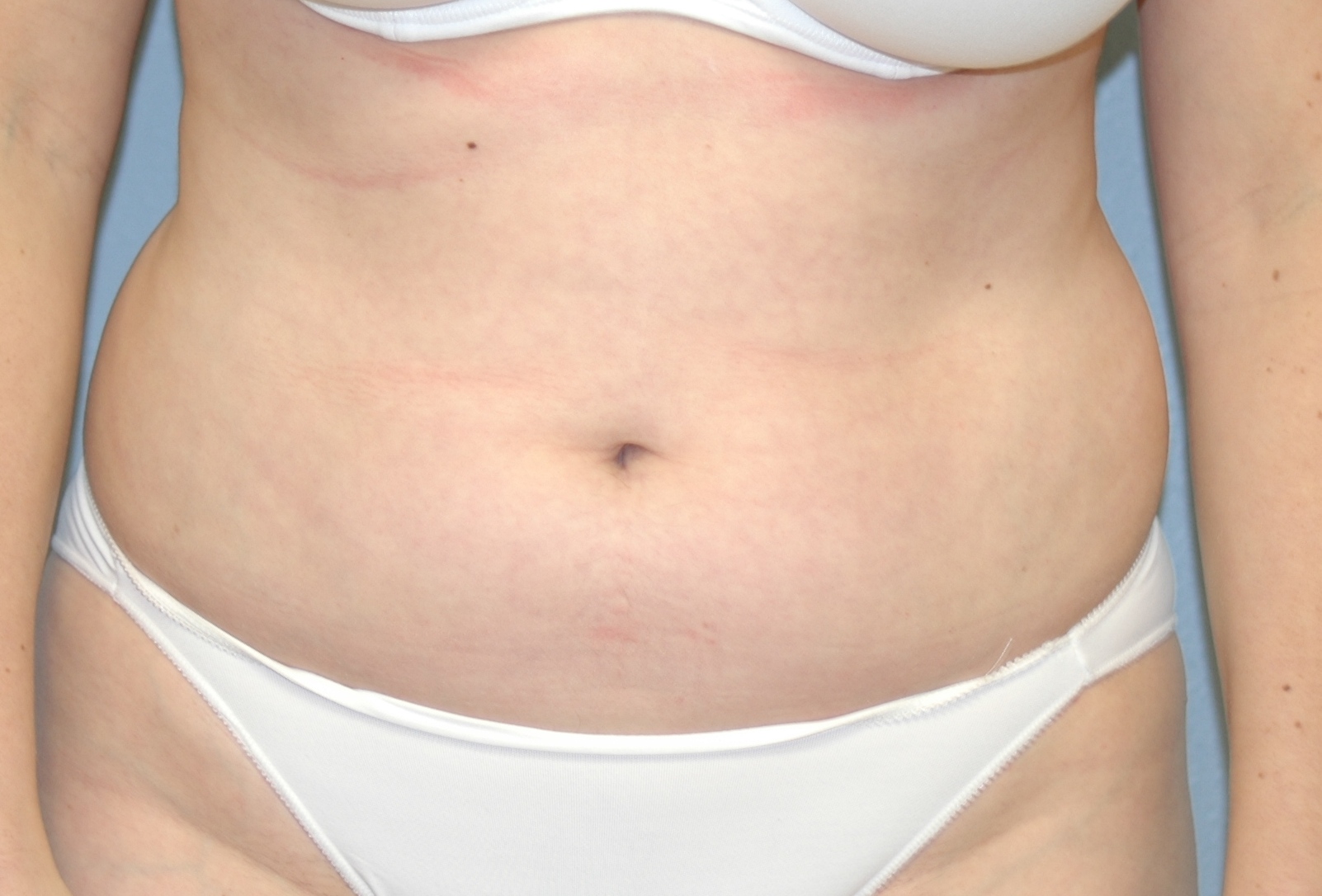 Case--9160 | Before Liposuction 1