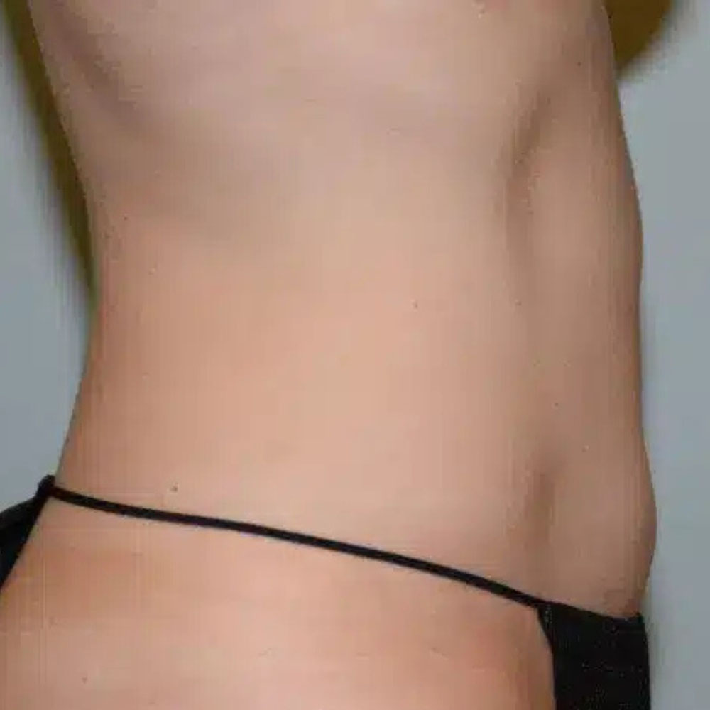 Case--2114 | After CoolSculpting