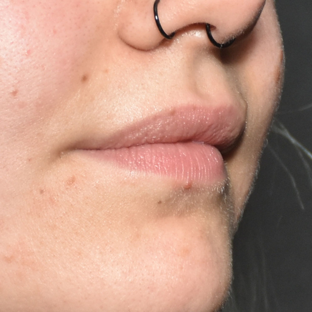 Case--2151 | Before Face Treatments