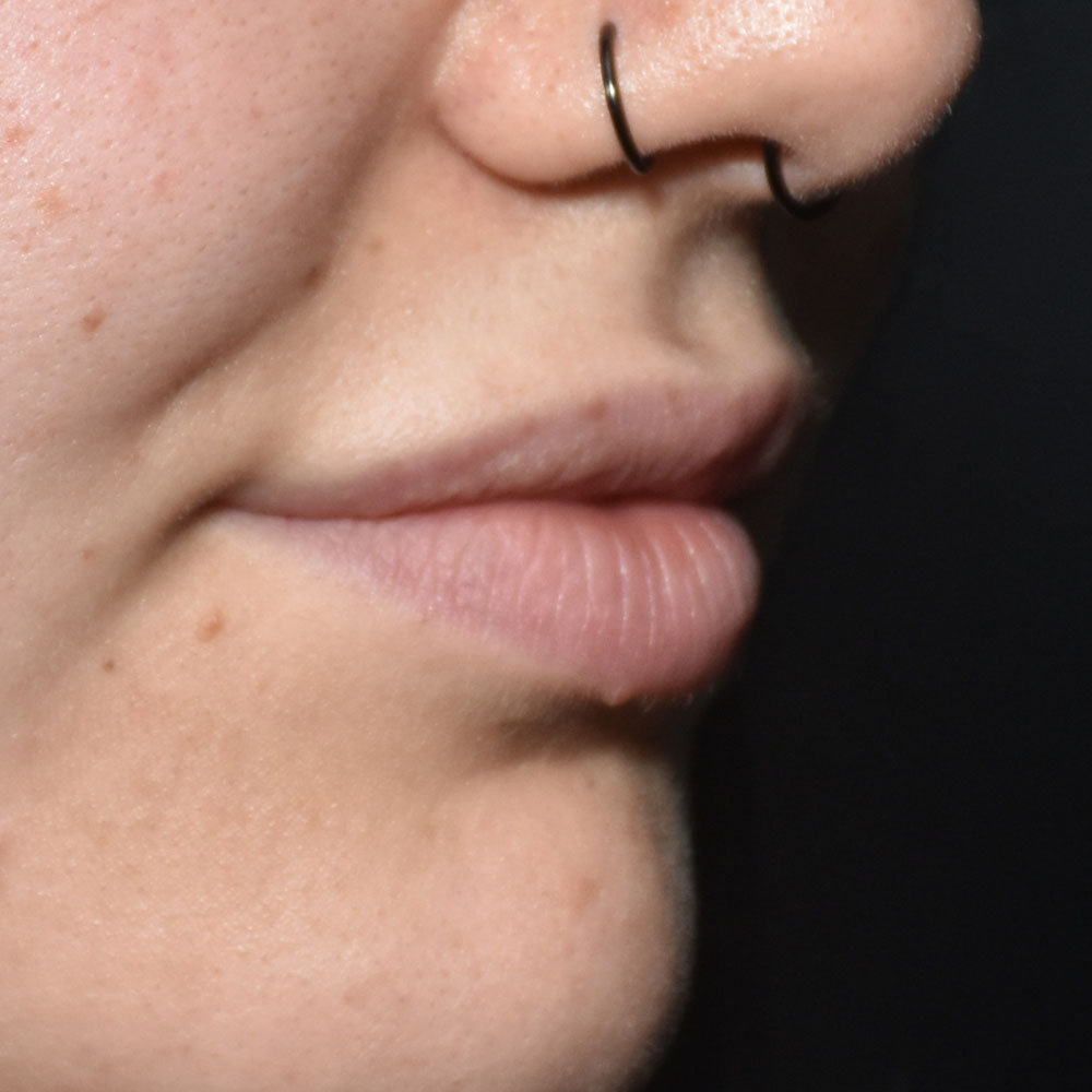 Case--2151 | After Face Treatments