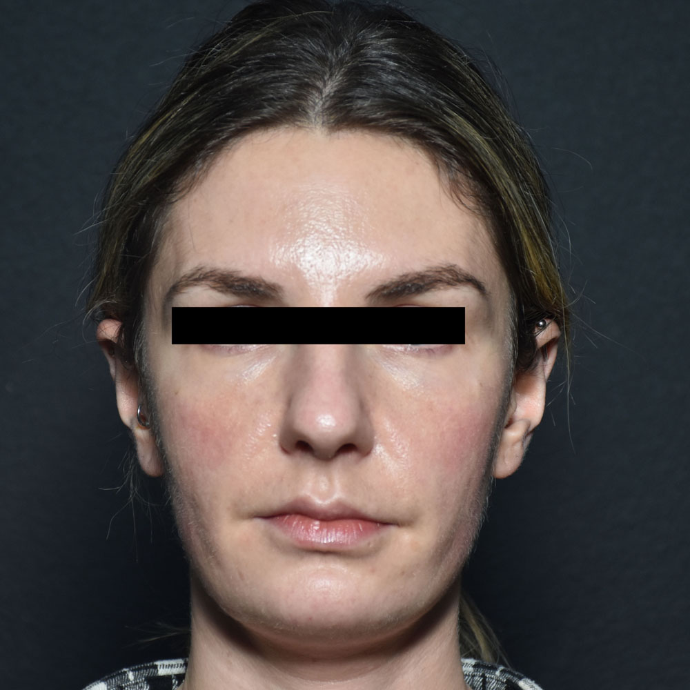 Case--2152 | Before Face Treatments