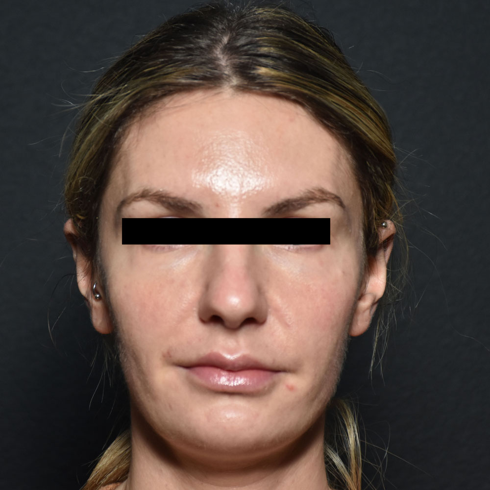Case--2152 | After Face Treatments