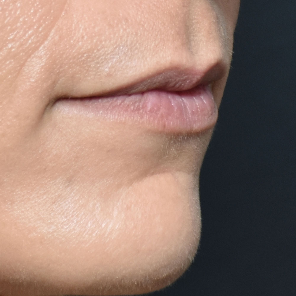 Case--2153 | Before Facial Fillers 3