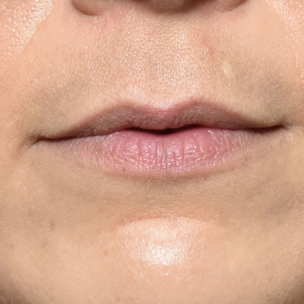 Case--2153 | Before Facial Fillers 1