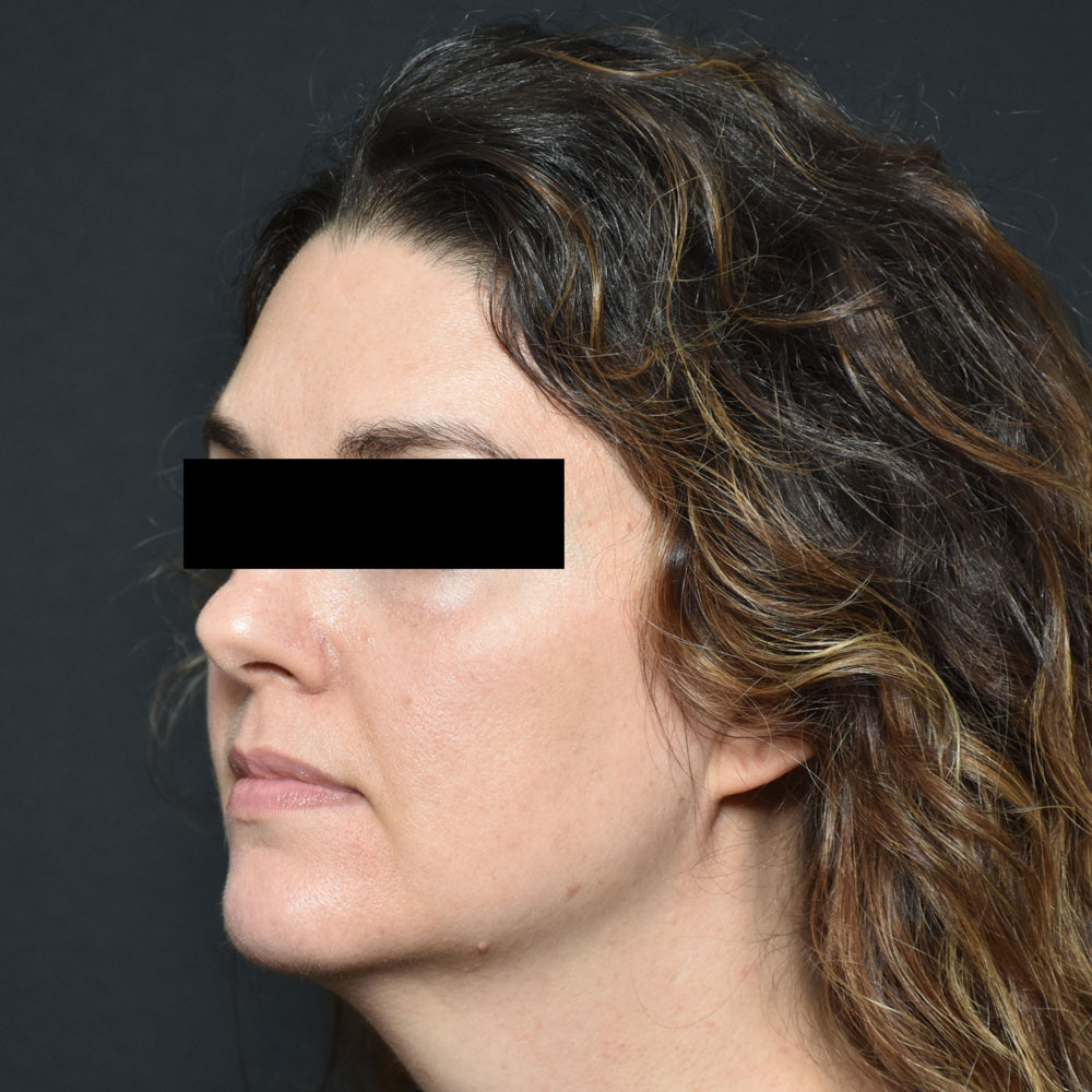 Case--2154 | After Facial Fillers 1