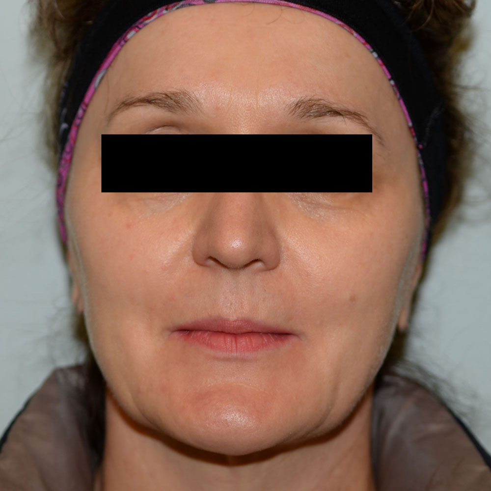 Case--2156 | Before Facial Fillers 1