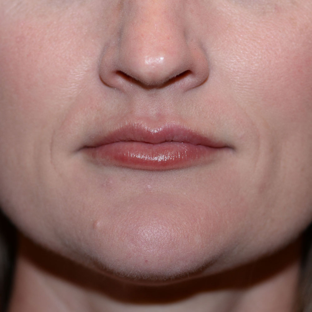Case--2141 | After Face Treatments
