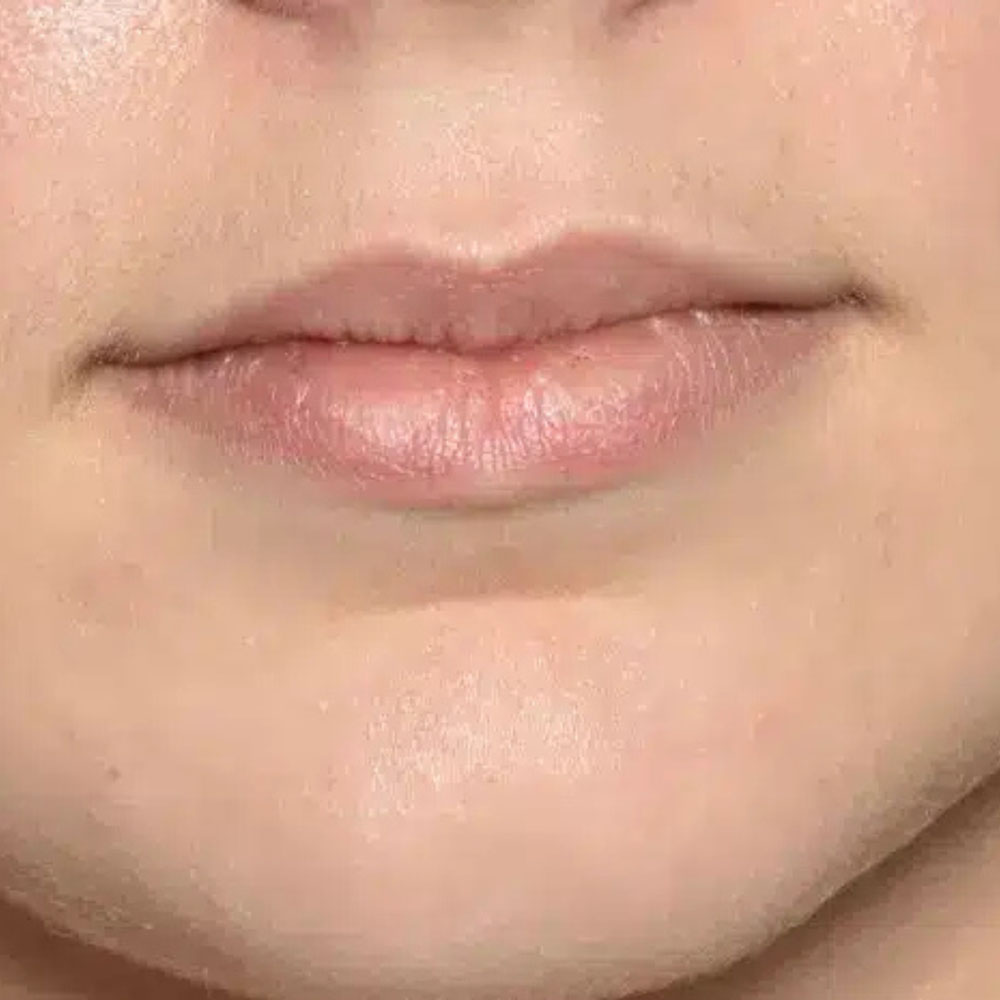 Case--2142 | Before Face Treatments