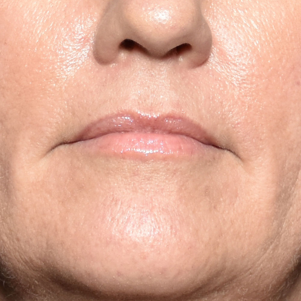 Case--2145 | Before Face Treatments