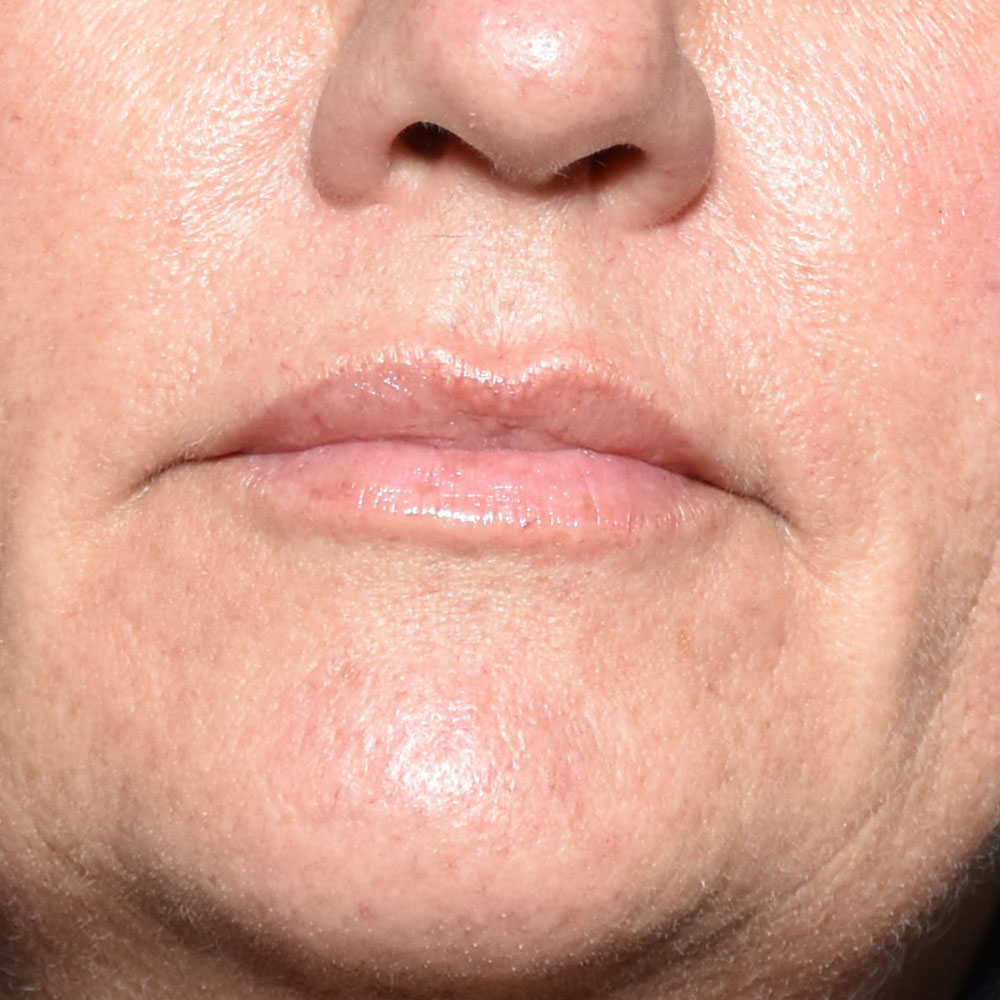 Case--2145 | After Face Treatments