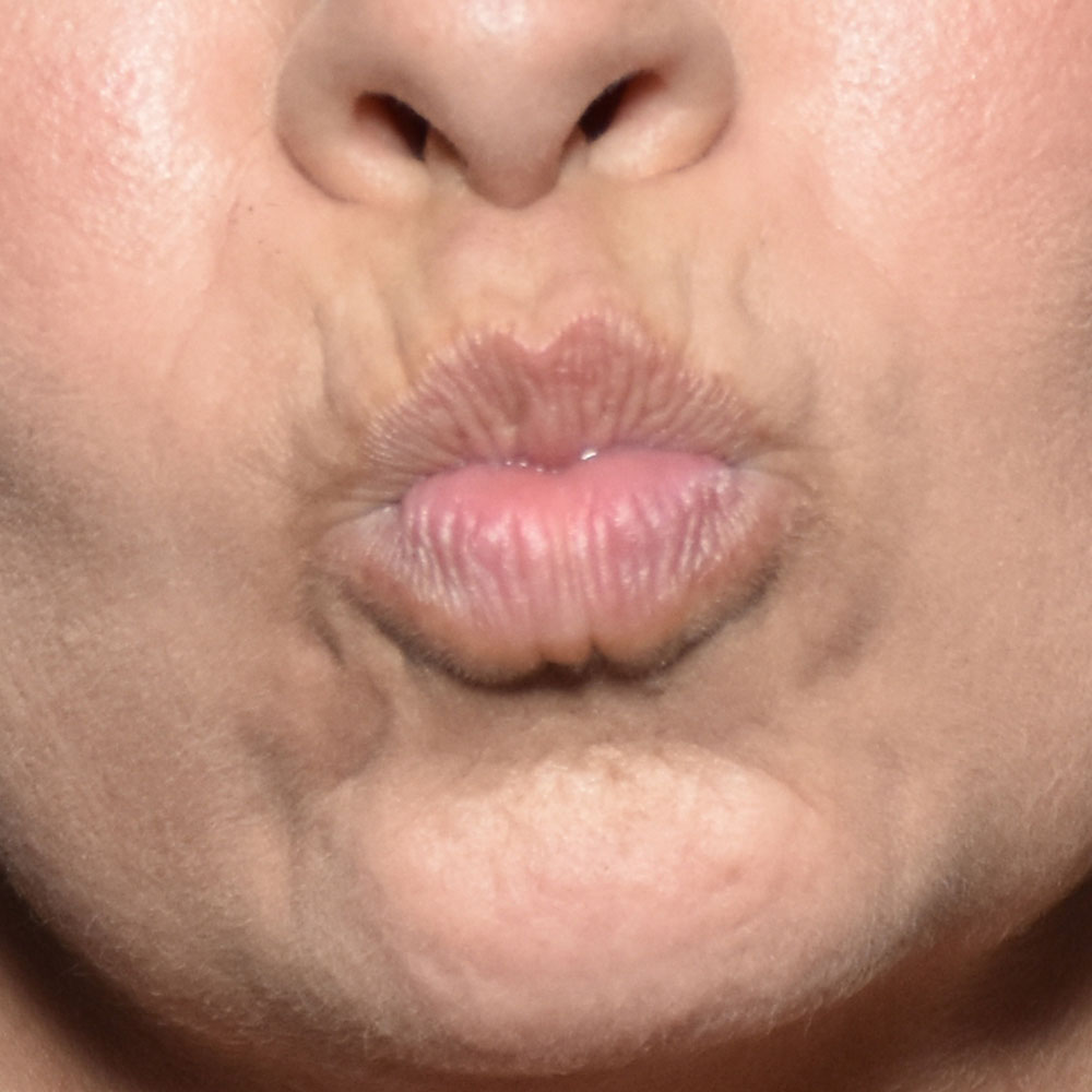 Case--2146 | Before Face Treatments